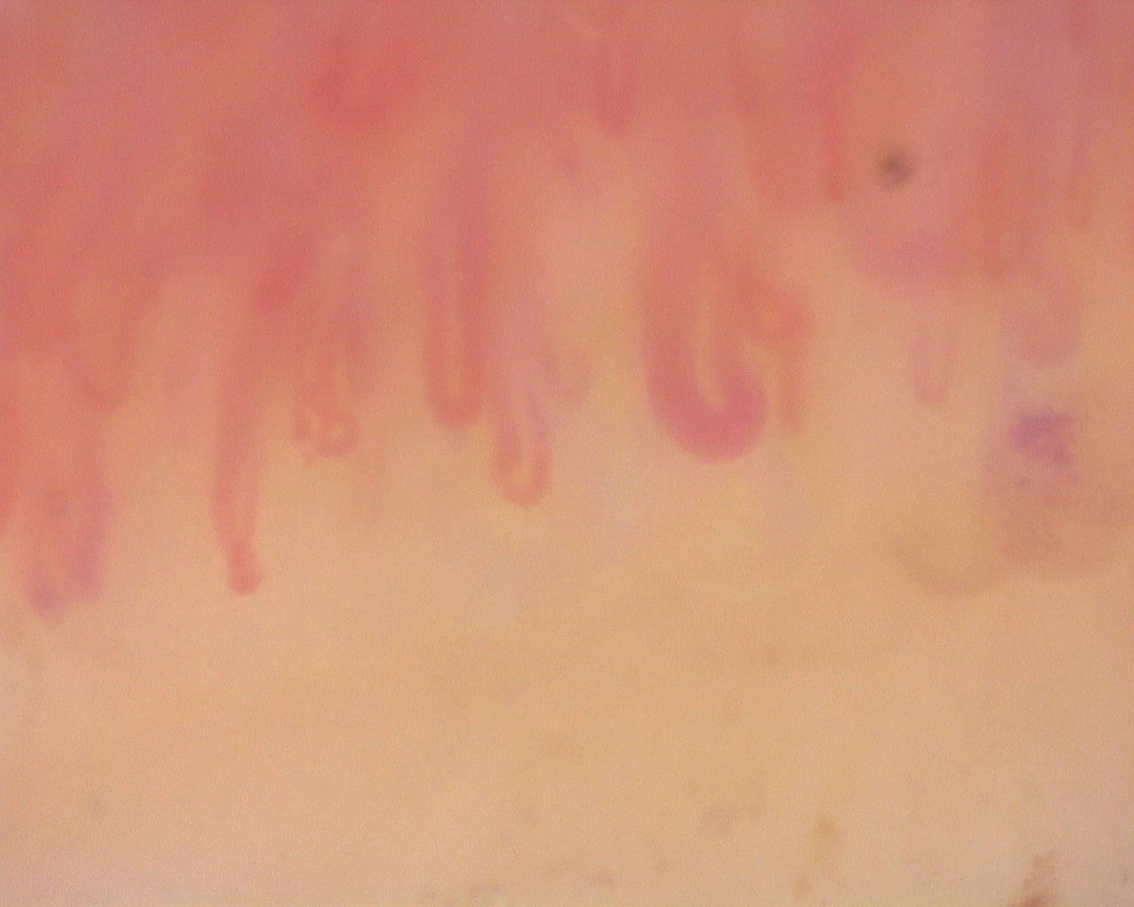 Nailfold capillaroscopy: left index finger, field a. Diffuse Systemic Sclerosis (Anti-Scl-70+) with Active Cutolo Pattern.