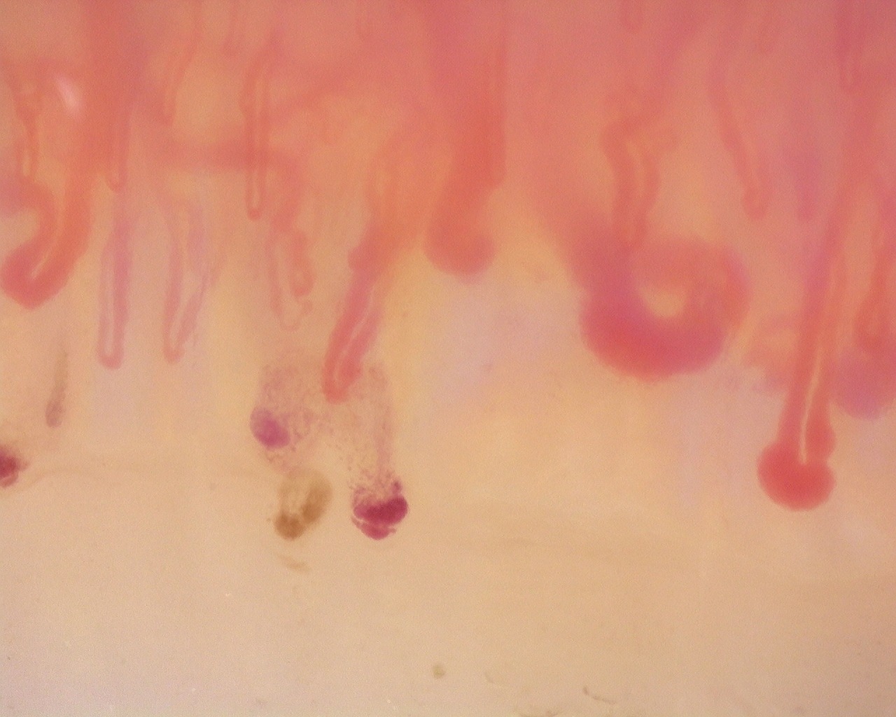 Diffuse Systemic Sclerosis (Anti-Scl-70+) with Active Cutolo Pattern