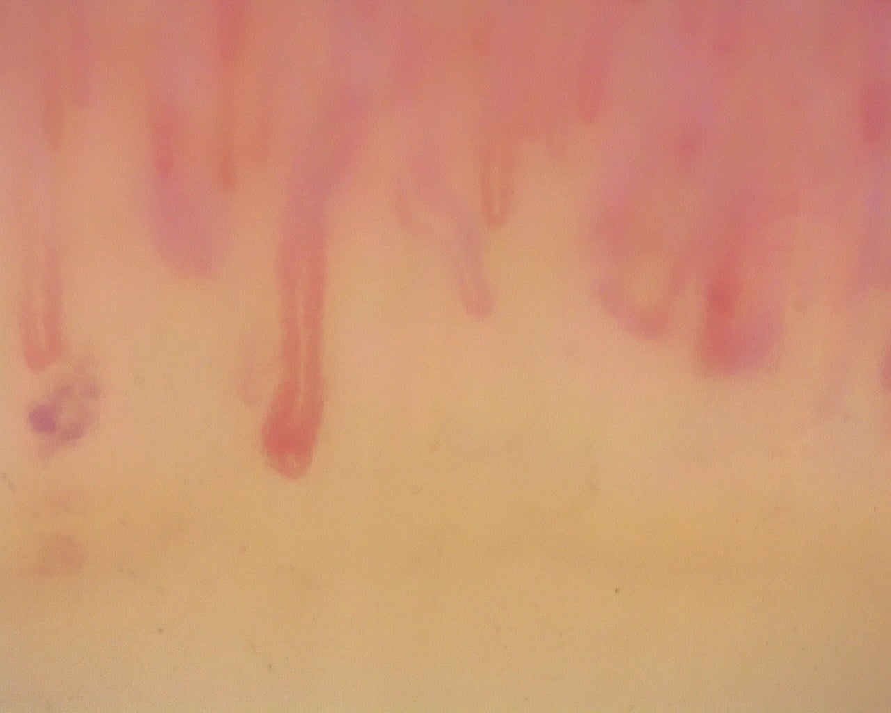 Nailfold capillaroscopy: right middle finger, field c. Diffuse Systemic Sclerosis (Anti-Scl-70+) with Active Cutolo Pattern.