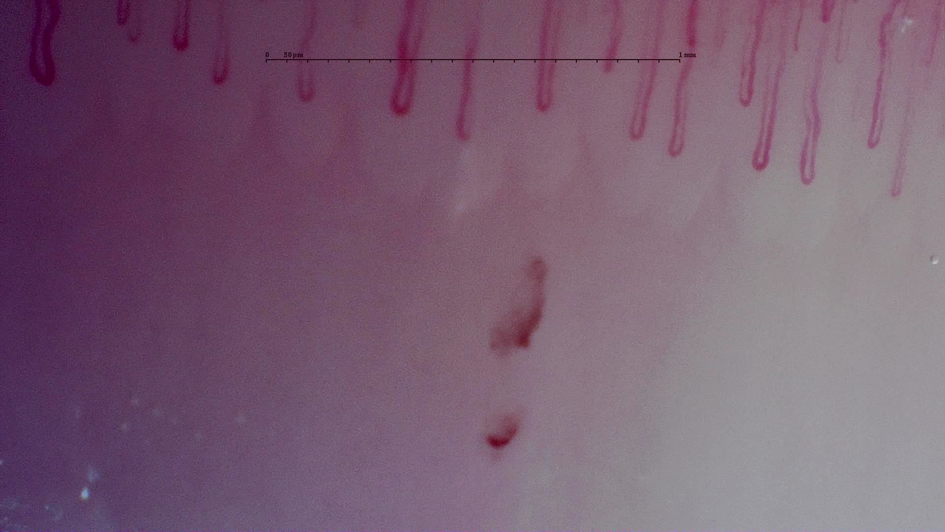 Nailfold capillaroscopy: right little finger, field c. MPO-ANCA Vasculitis with Rapidly Progressive Glomerulonephritis.