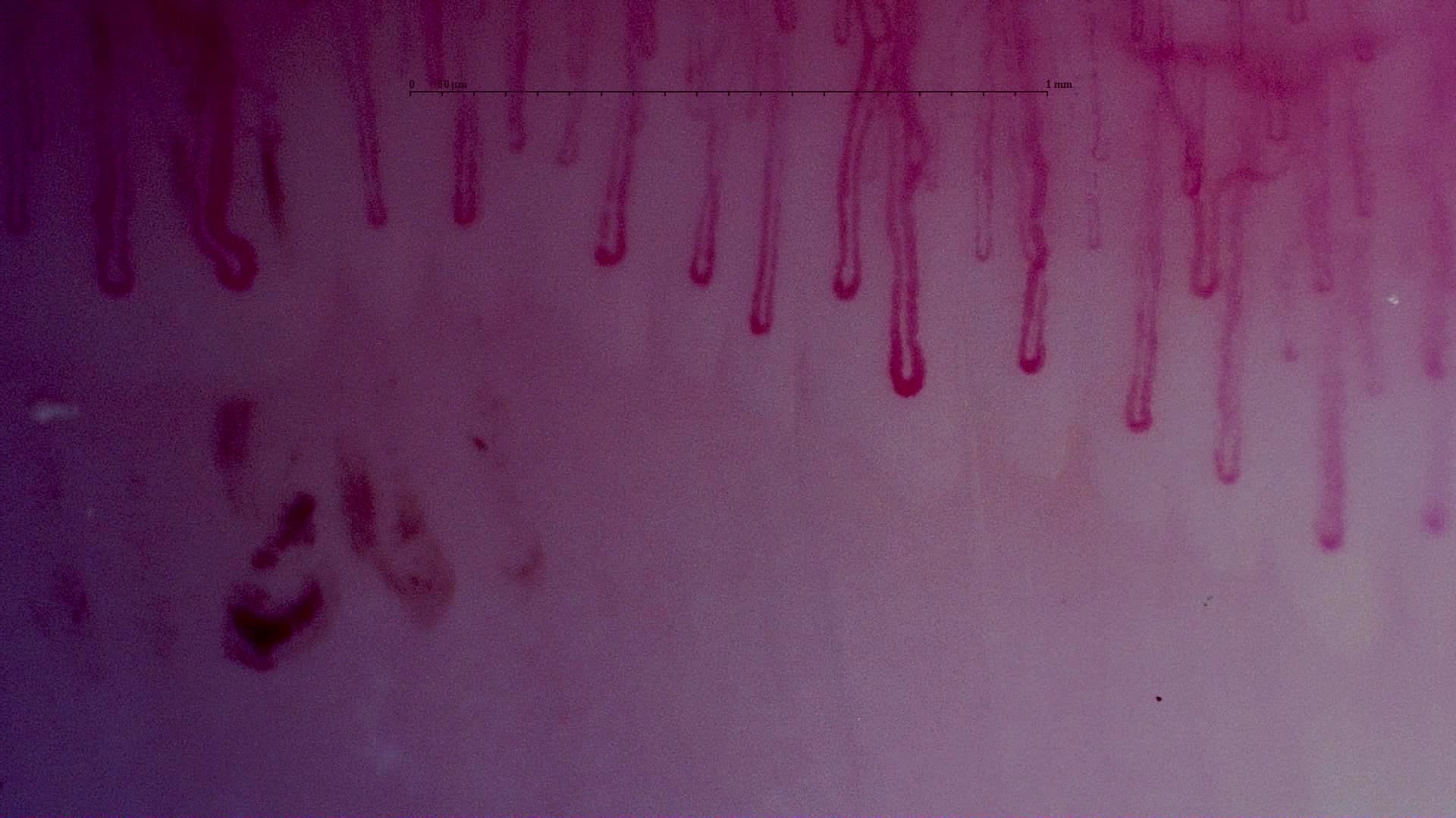 Nailfold capillaroscopy: right little finger, field a. MPO-ANCA Vasculitis with Rapidly Progressive Glomerulonephritis.
