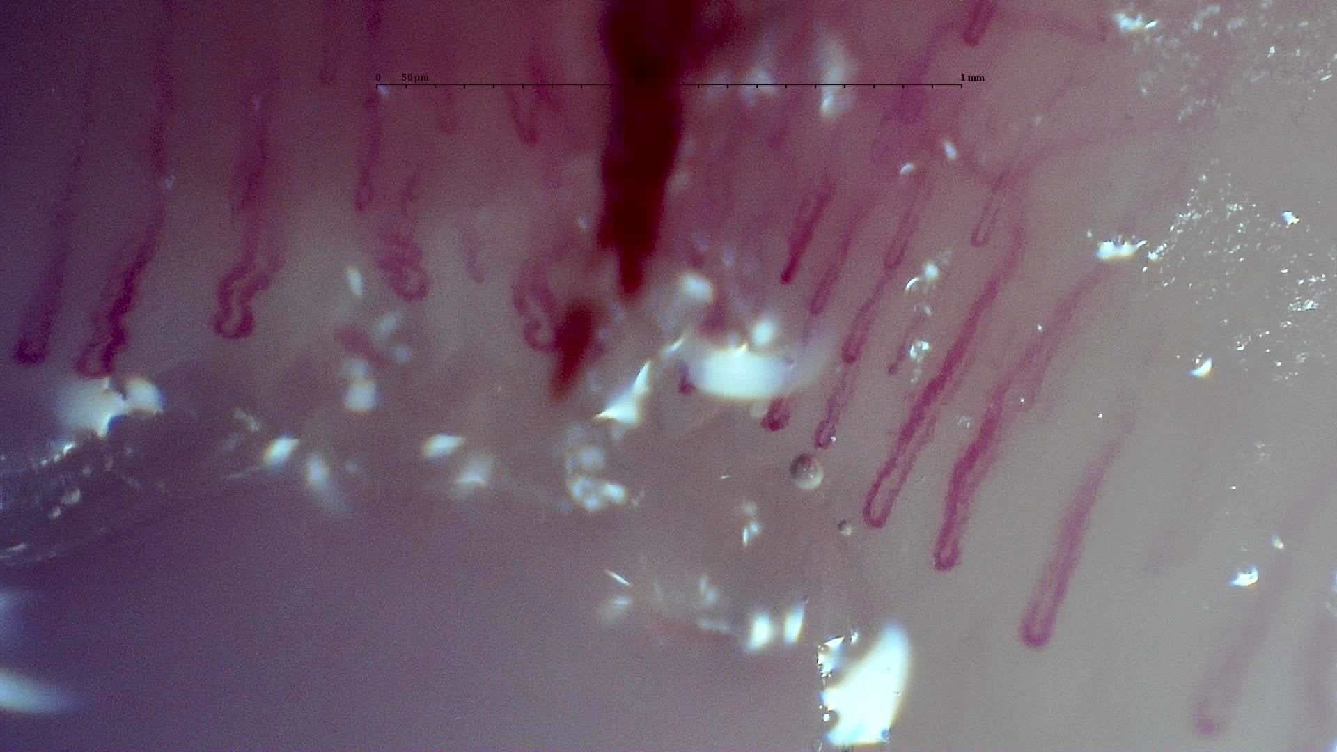 Nailfold capillaroscopy: right ring finger, field c. MPO-ANCA Vasculitis with Rapidly Progressive Glomerulonephritis.