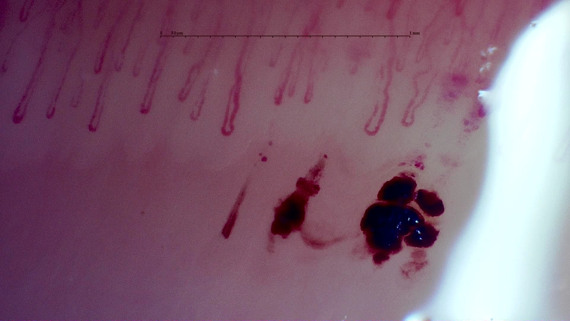 Preview image for MPO-ANCA Vasculitis with Rapidly Progressive Glomerulonephritis