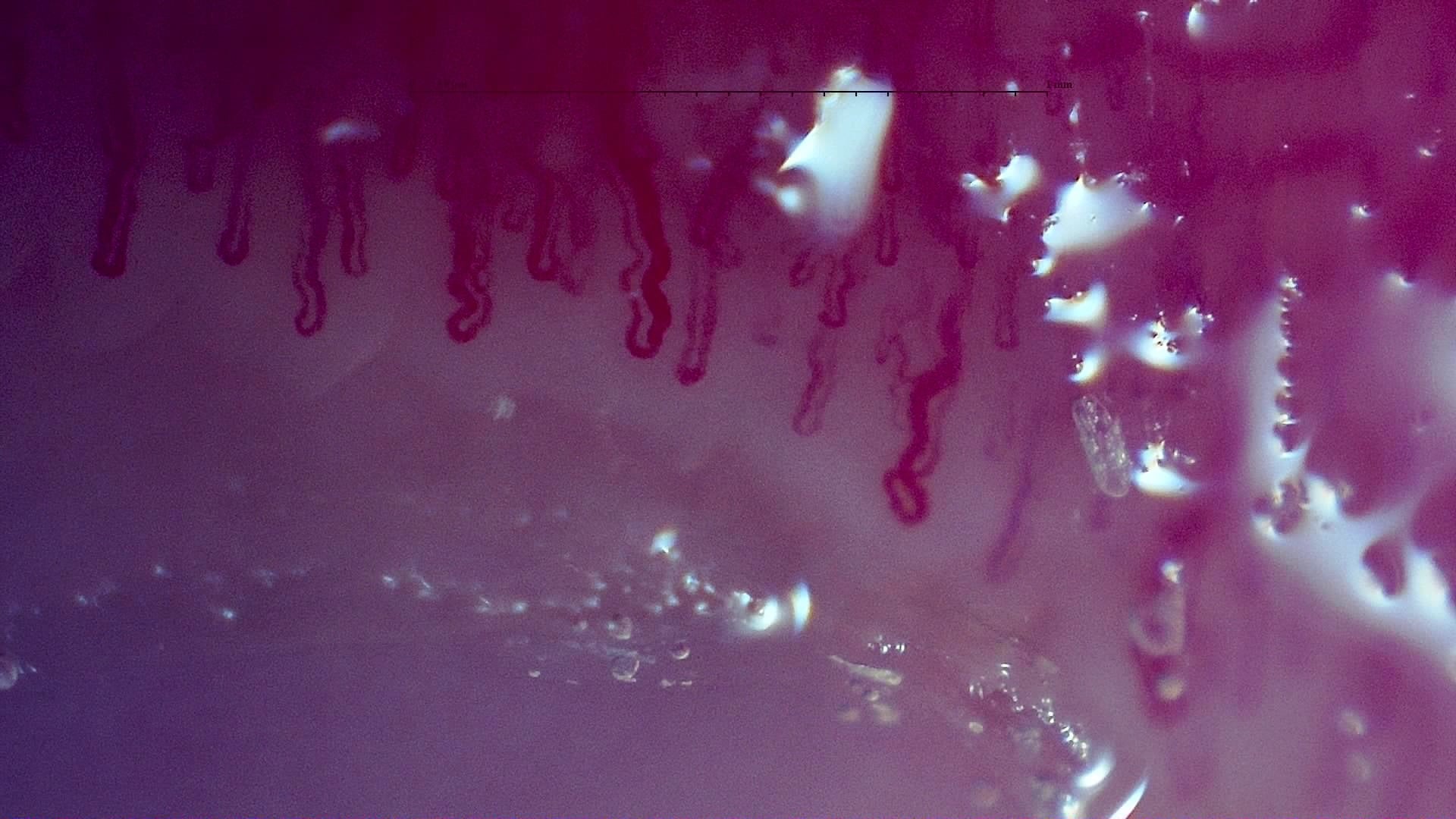 Nailfold capillaroscopy: left little finger, field d. MPO-ANCA Vasculitis with Rapidly Progressive Glomerulonephritis.