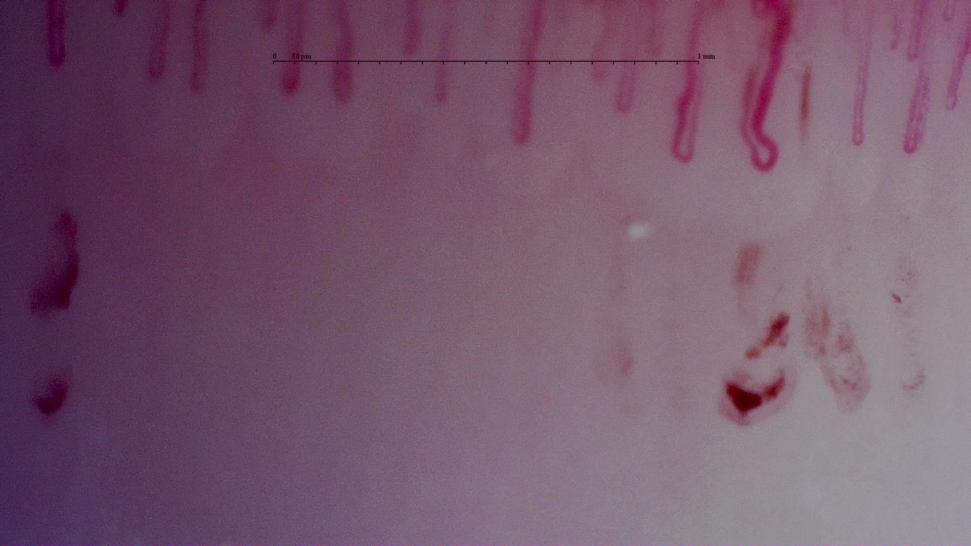 Nailfold capillaroscopy: right little finger, field b. MPO-ANCA Vasculitis with Rapidly Progressive Glomerulonephritis.