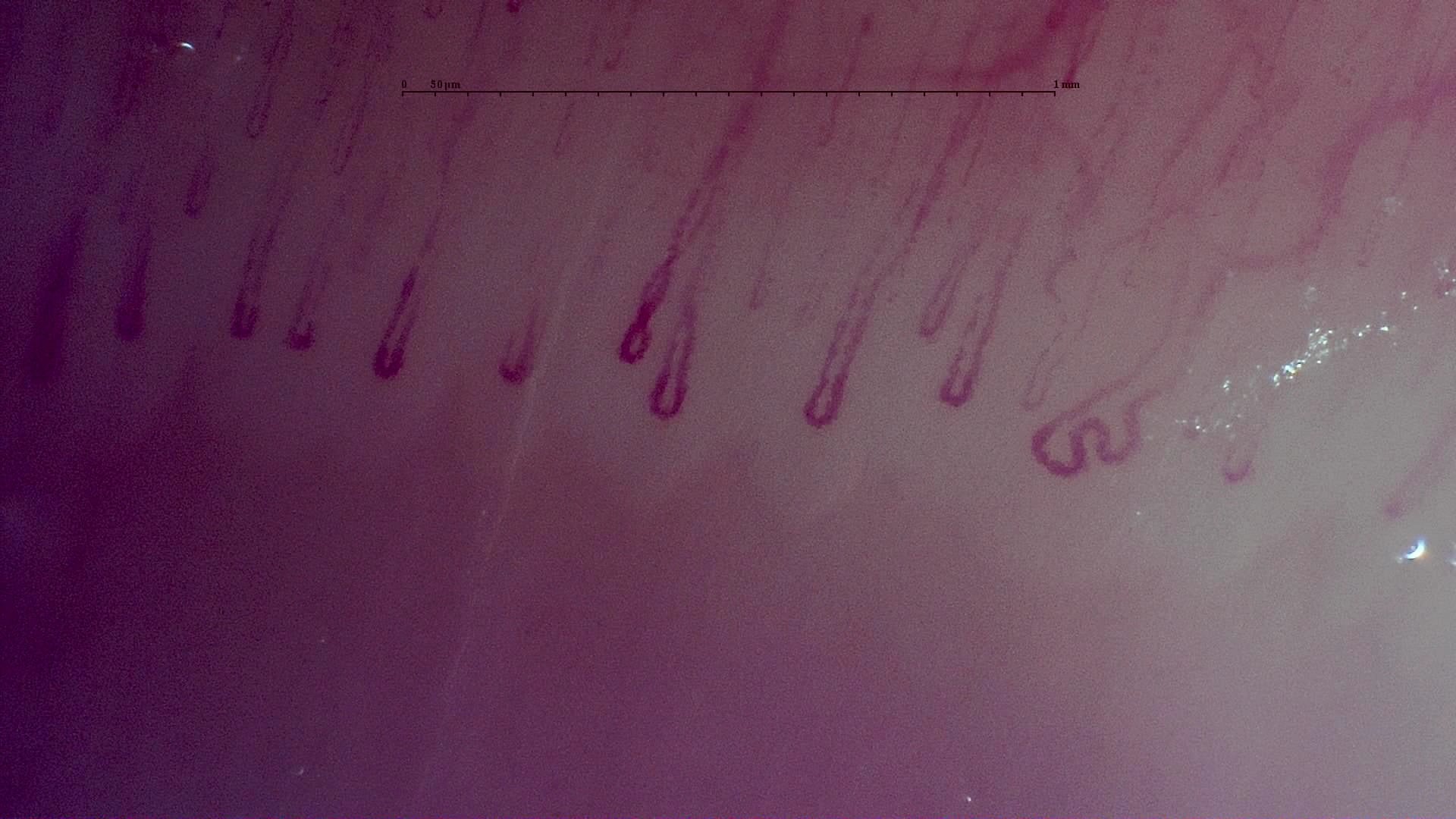 Nailfold capillaroscopy: left index finger, field b. MPO-ANCA Vasculitis with Rapidly Progressive Glomerulonephritis.