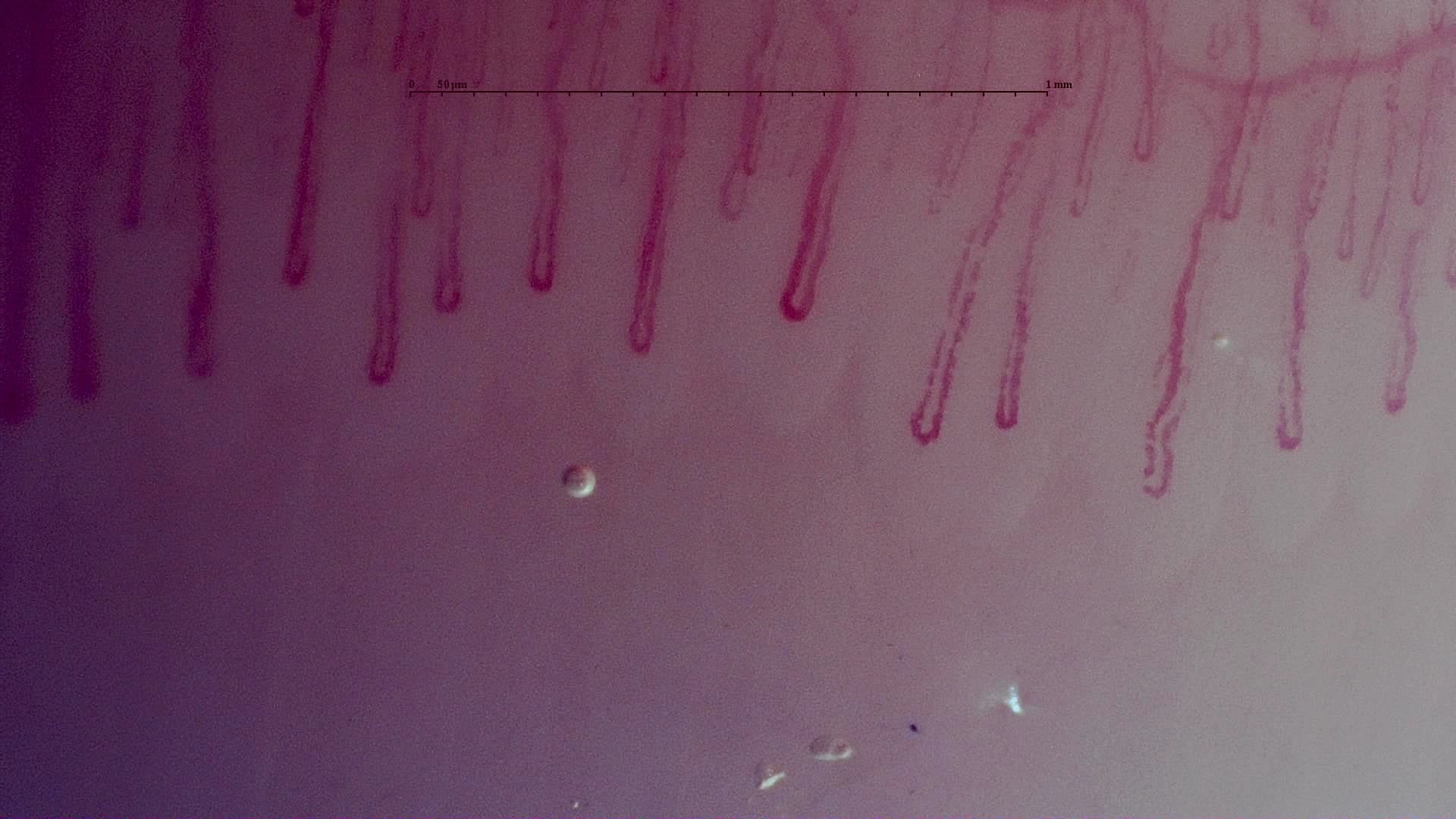 Nailfold capillaroscopy: left ring finger, field b. MPO-ANCA Vasculitis with Rapidly Progressive Glomerulonephritis.