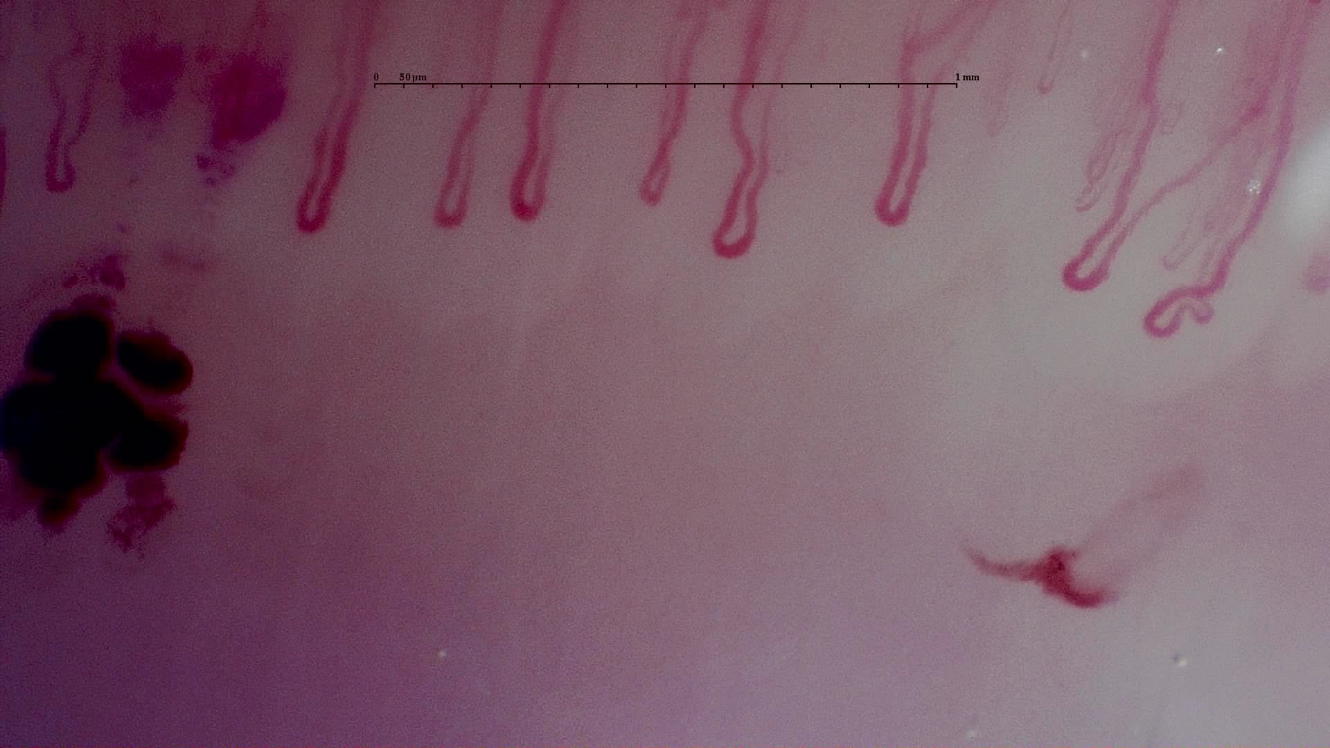 Nailfold capillaroscopy: right index finger, field c. MPO-ANCA Vasculitis with Rapidly Progressive Glomerulonephritis.