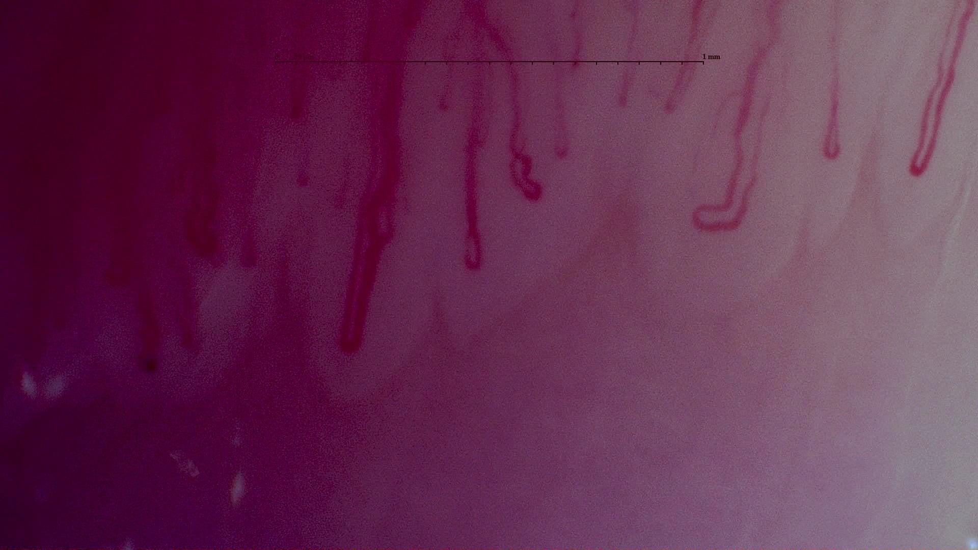 Nailfold capillaroscopy: left little finger, field a. MPO-ANCA Vasculitis with Rapidly Progressive Glomerulonephritis.