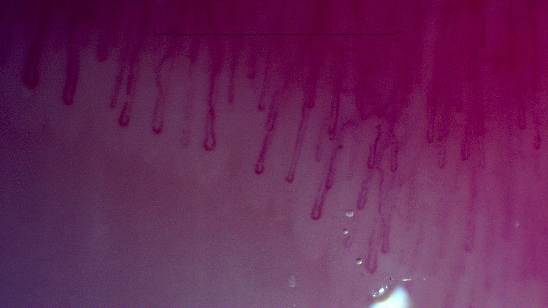 Nailfold capillaroscopy: left index finger, field d. MPO-ANCA Vasculitis with Rapidly Progressive Glomerulonephritis.