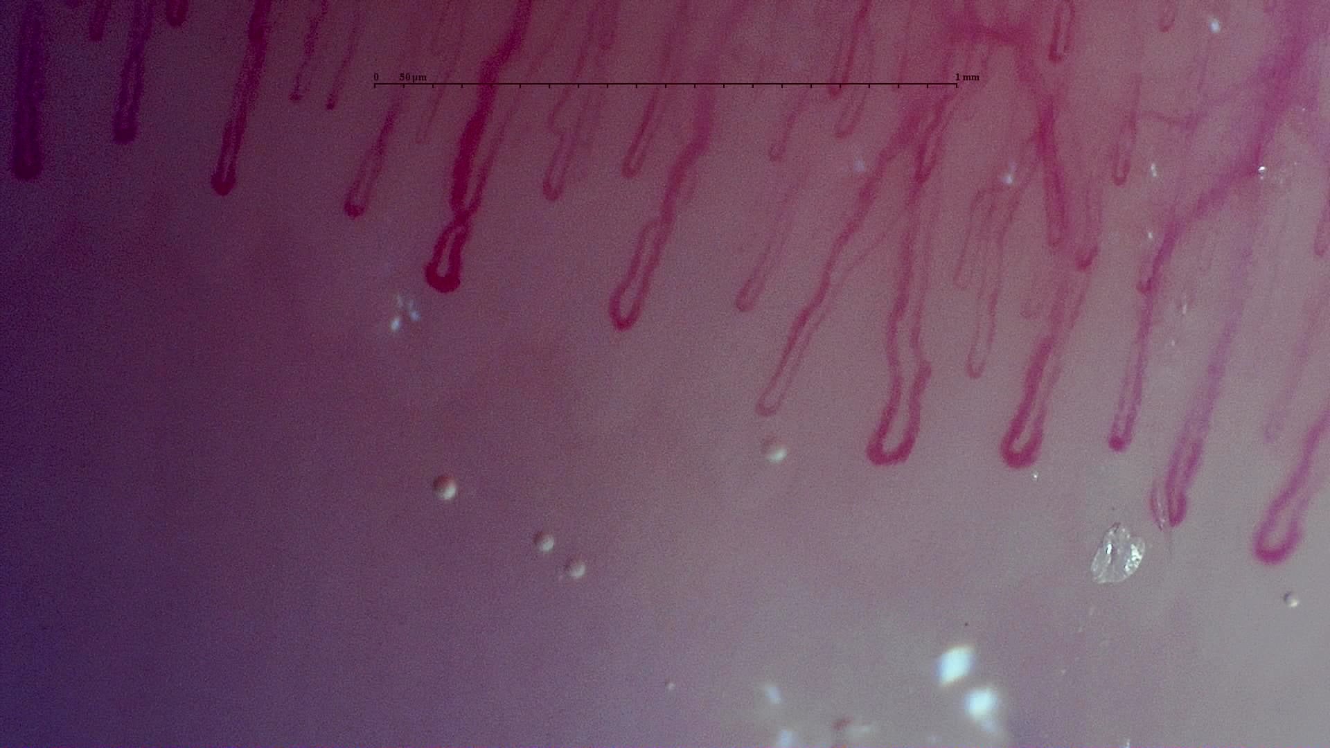 Nailfold capillaroscopy: left ring finger, field c. MPO-ANCA Vasculitis with Rapidly Progressive Glomerulonephritis.