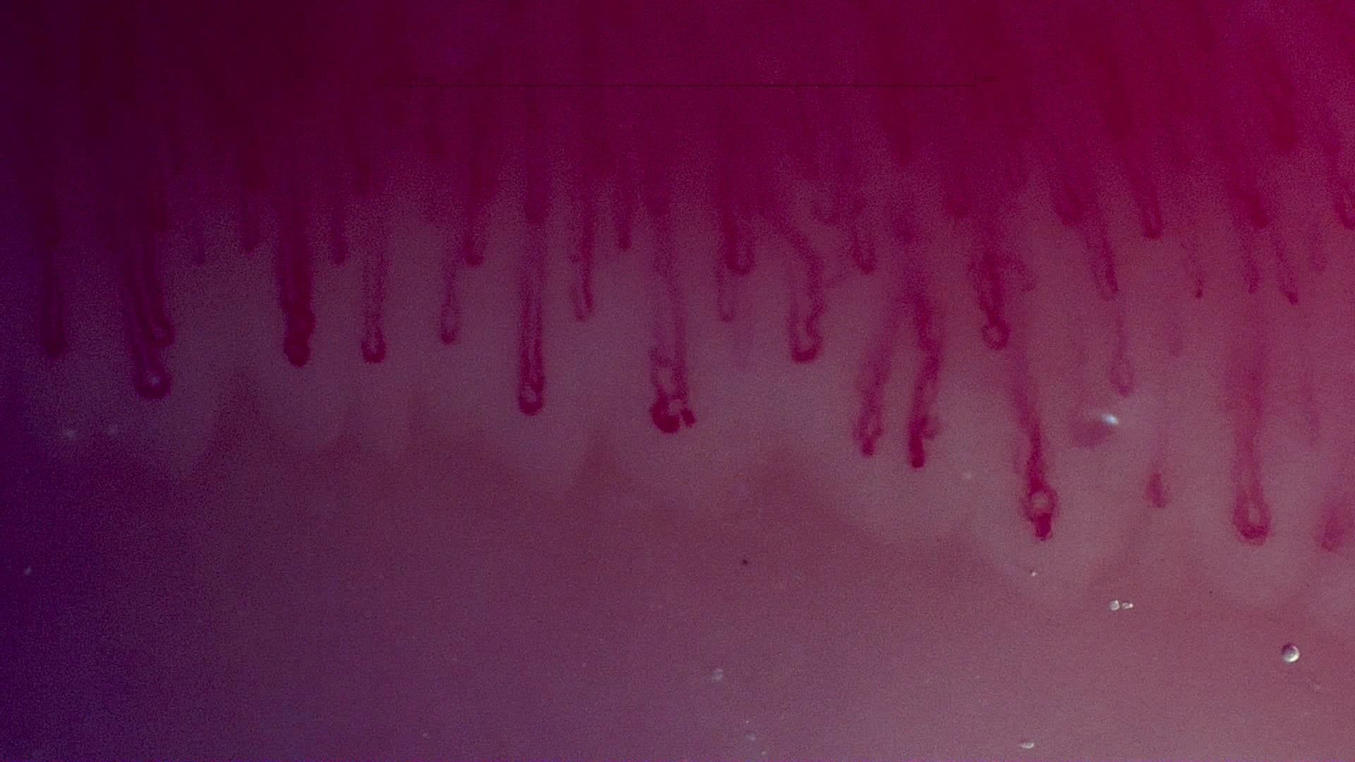 Nailfold capillaroscopy: right index finger, field a. MPO-ANCA Vasculitis with Rapidly Progressive Glomerulonephritis.