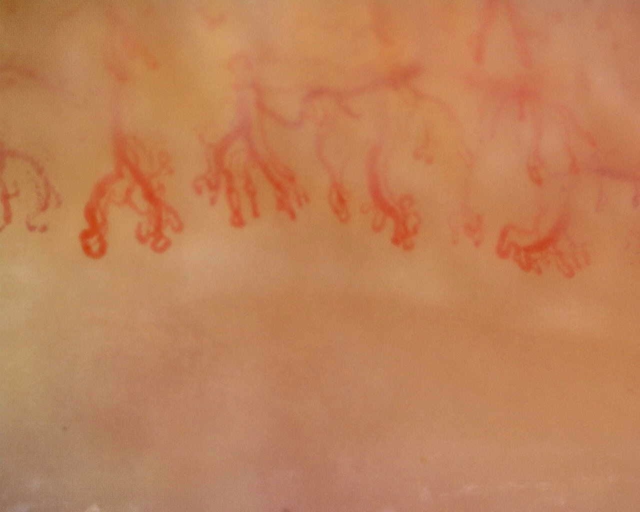 Nailfold capillaroscopy: right little finger, field a. Anti-Mi2β Dermatomyositis in Active Disease.
