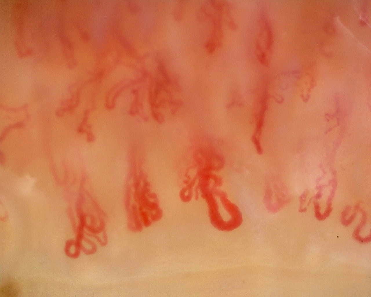 Nailfold capillaroscopy: right middle finger, field b. Anti-Mi2β Dermatomyositis in Active Disease.