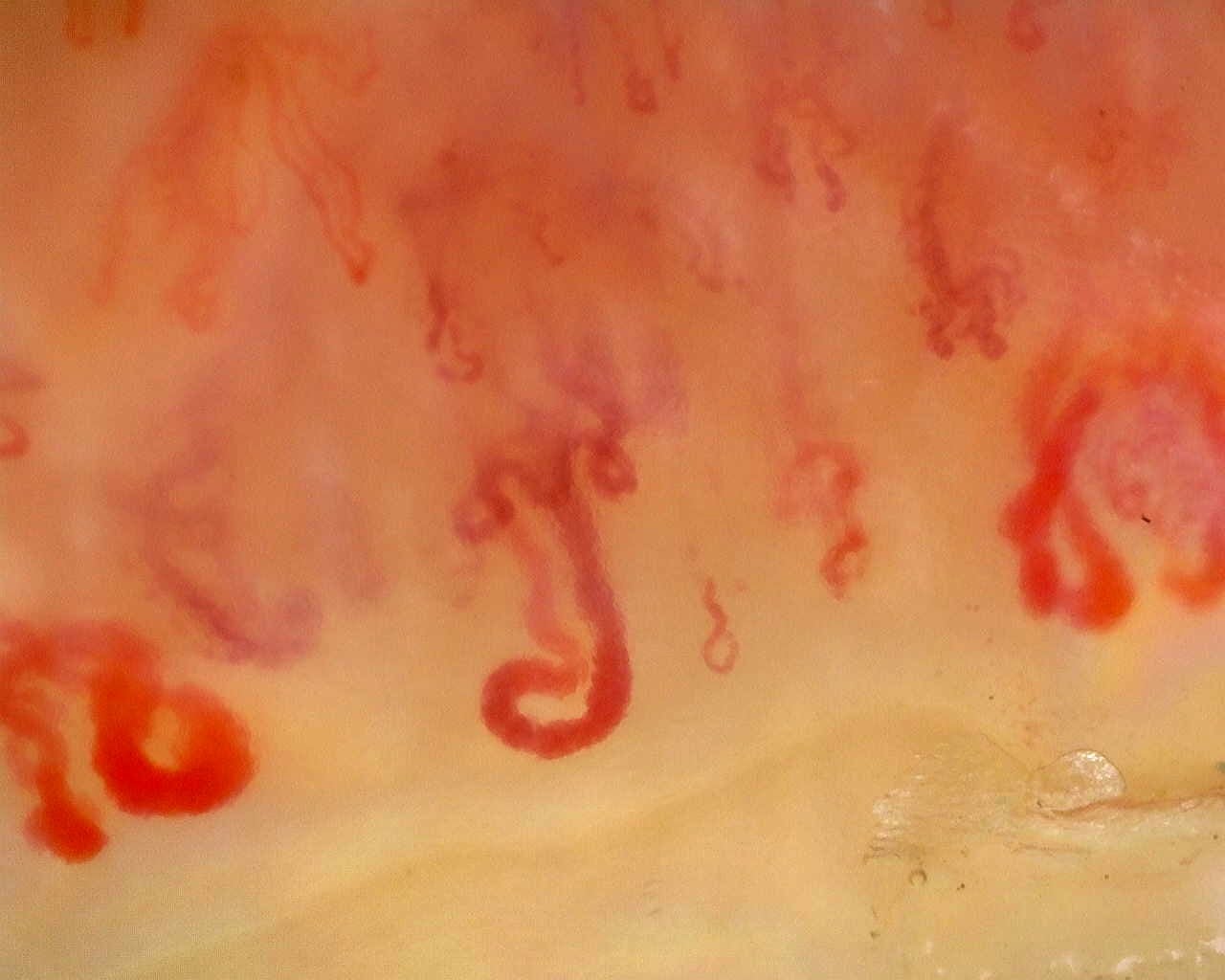 Nailfold capillaroscopy: right middle finger, field d. Anti-Mi2β Dermatomyositis in Active Disease.