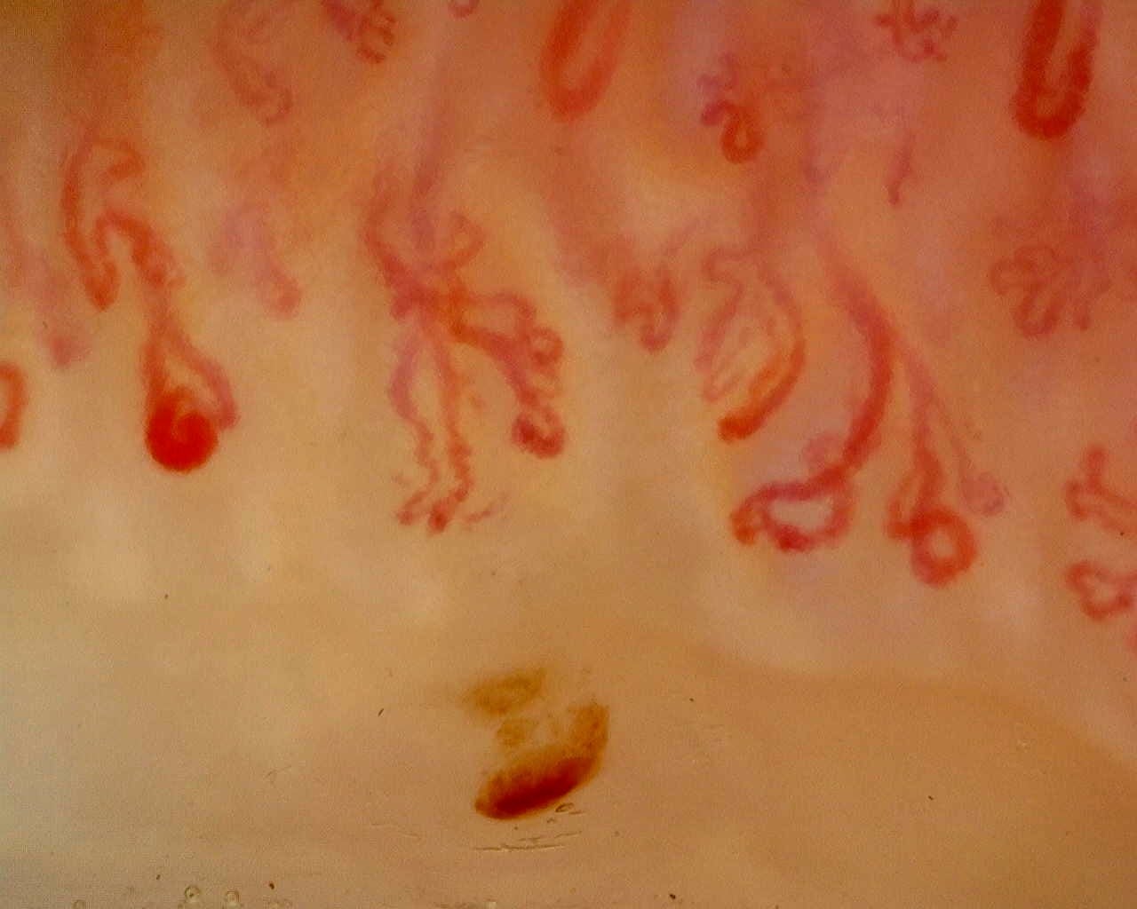 Nailfold capillaroscopy: right index finger, field a. Anti-Mi2β Dermatomyositis in Active Disease.