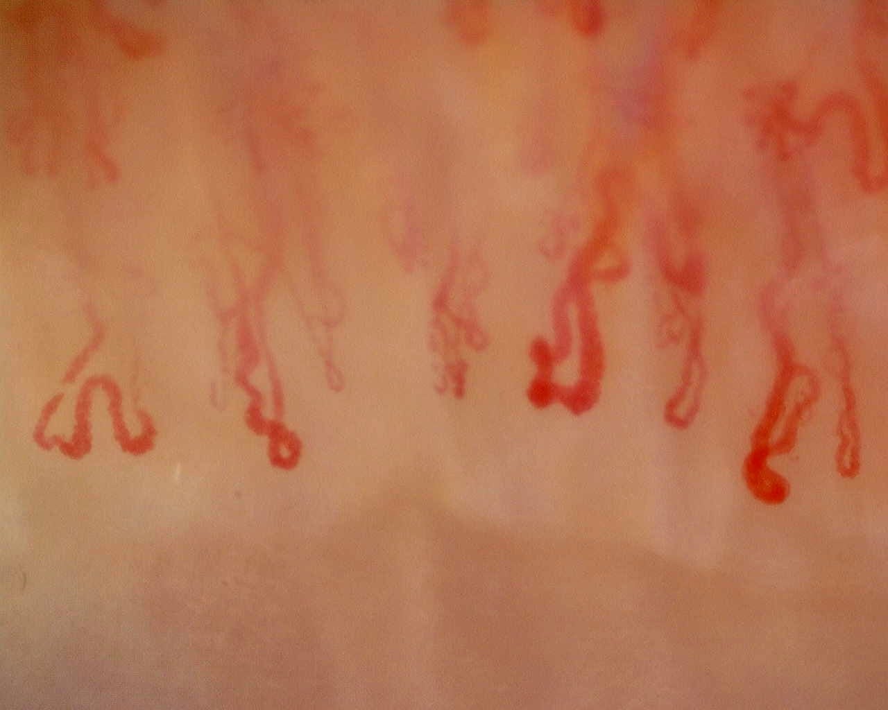 Nailfold capillaroscopy: right ring finger, field a. Anti-Mi2β Dermatomyositis in Active Disease.