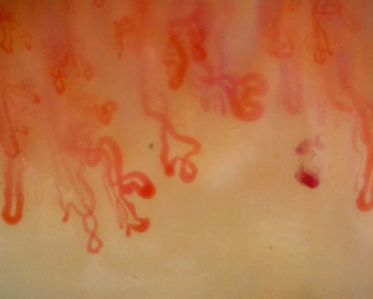 Nailfold capillaroscopy: right ring finger, field c. Anti-Mi2β Dermatomyositis in Active Disease.