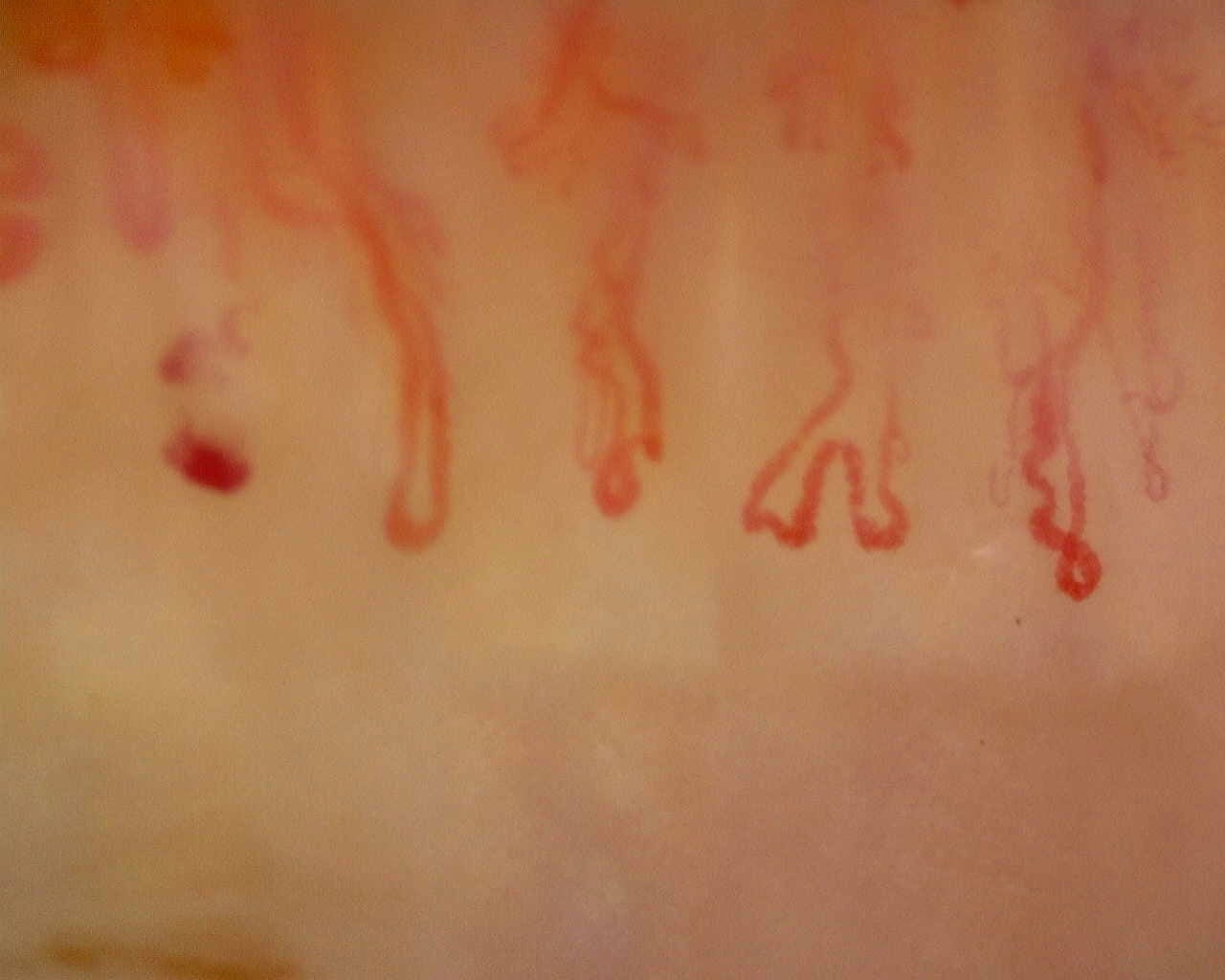 Nailfold capillaroscopy: right ring finger, field b. Anti-Mi2β Dermatomyositis in Active Disease.