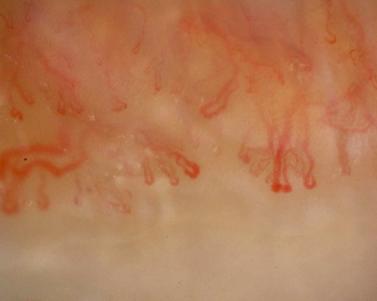 Nailfold capillaroscopy: right little finger, field c. Anti-Mi2β Dermatomyositis in Active Disease.