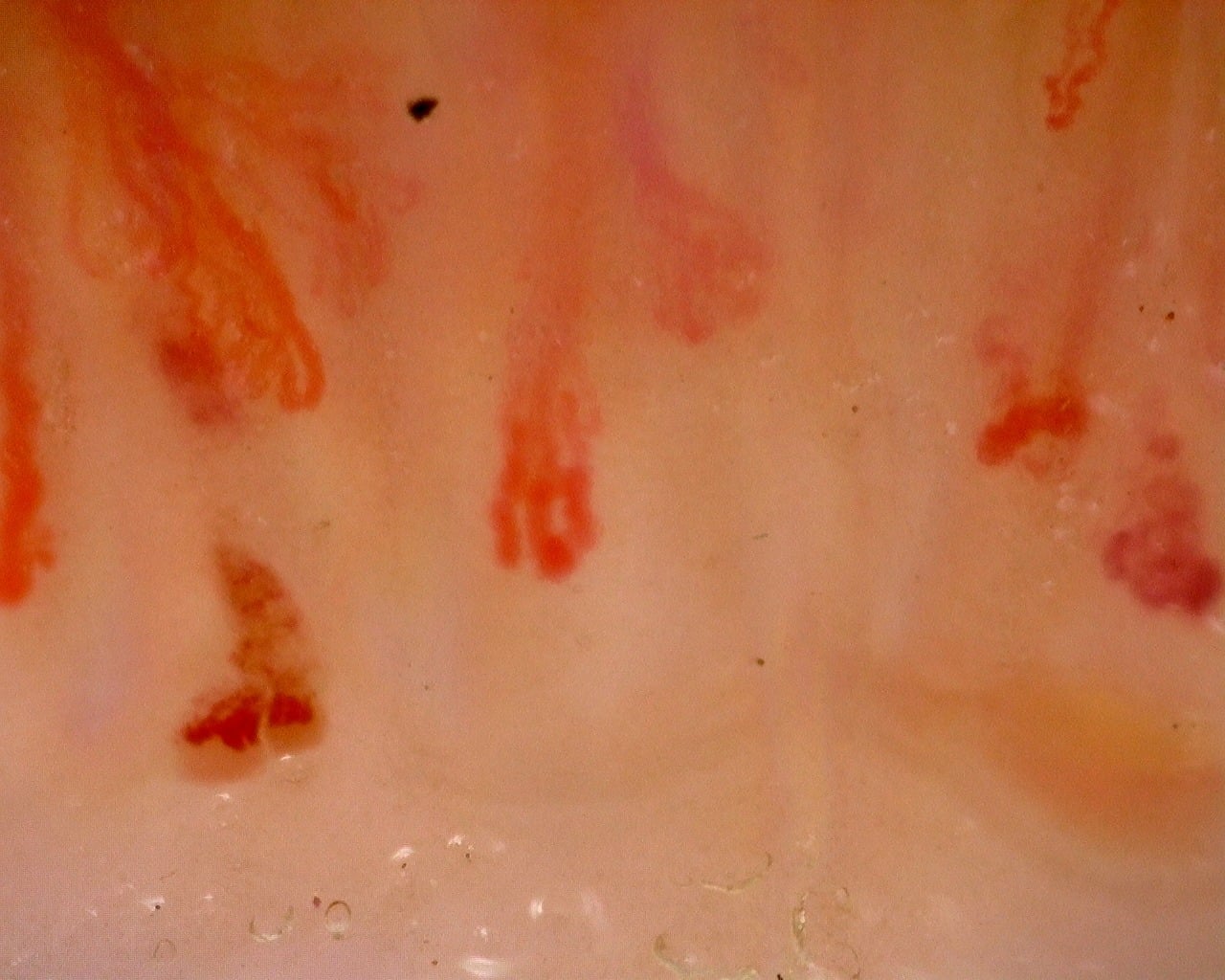 Nailfold capillaroscopy: right ring finger, field b. Juvenile Dermatomyositis with Gottron Lesions and a Scleroderma-Like Pattern.