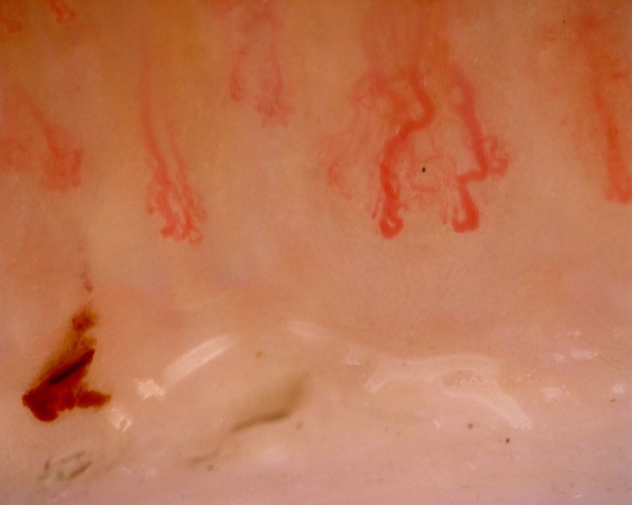 Nailfold capillaroscopy: left little finger, field b. Juvenile Dermatomyositis with Gottron Lesions and a Scleroderma-Like Pattern.