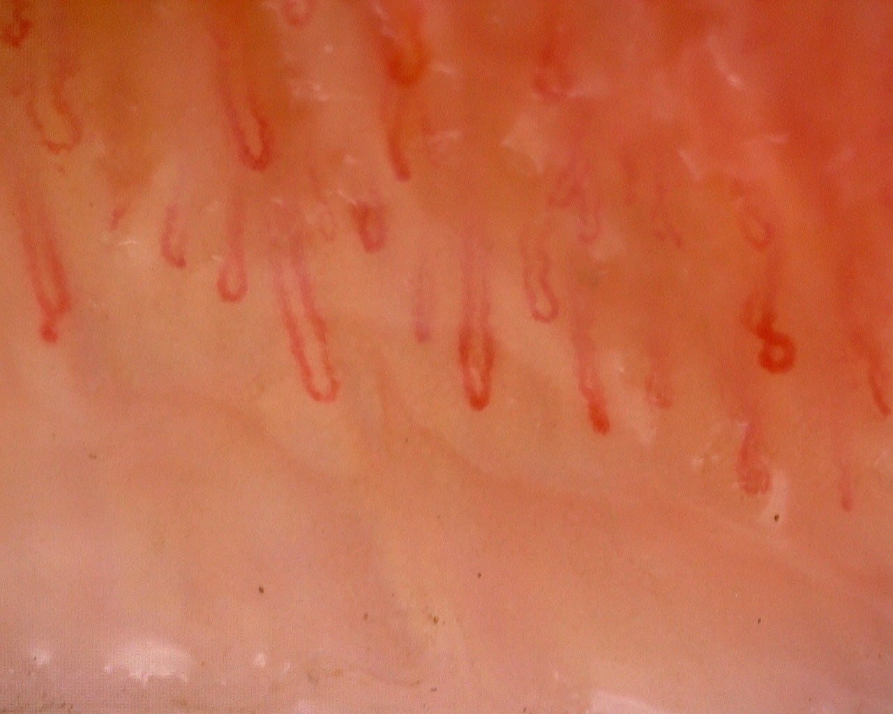 Nailfold capillaroscopy: left ring finger, field a. Juvenile Dermatomyositis with Gottron Lesions and a Scleroderma-Like Pattern.