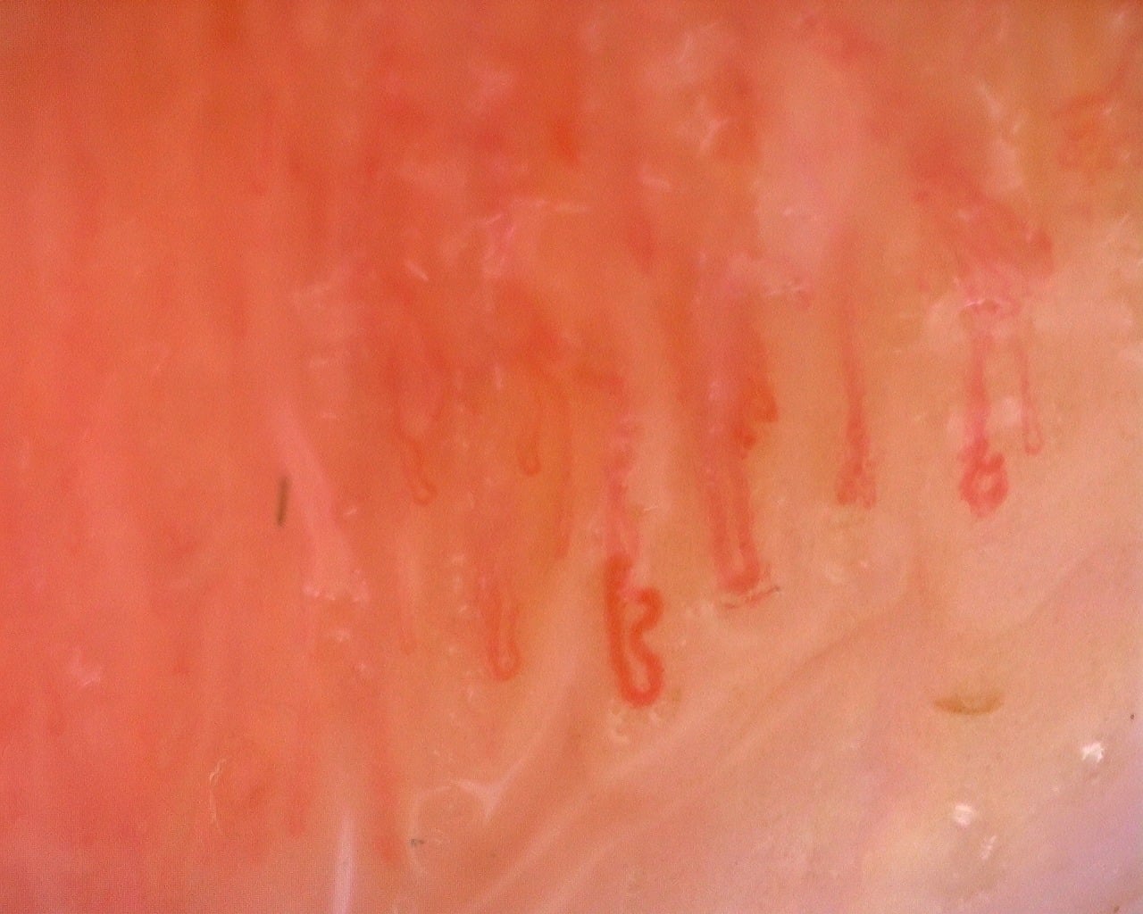 Nailfold capillaroscopy: left little finger, field c. Juvenile Dermatomyositis with Gottron Lesions and a Scleroderma-Like Pattern.
