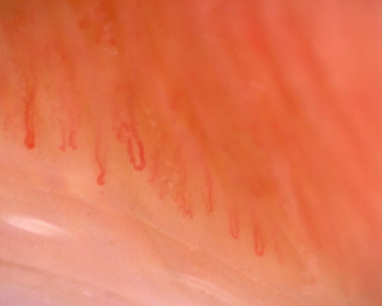 Nailfold capillaroscopy: left little finger, field a. Juvenile Dermatomyositis with Gottron Lesions and a Scleroderma-Like Pattern.