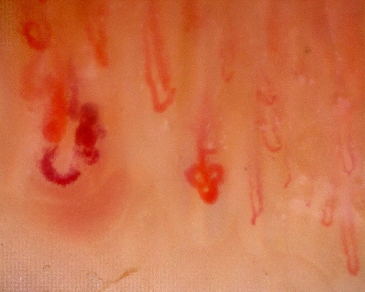 Nailfold capillaroscopy: left ring finger, field b. Juvenile Dermatomyositis with Gottron Lesions and a Scleroderma-Like Pattern.