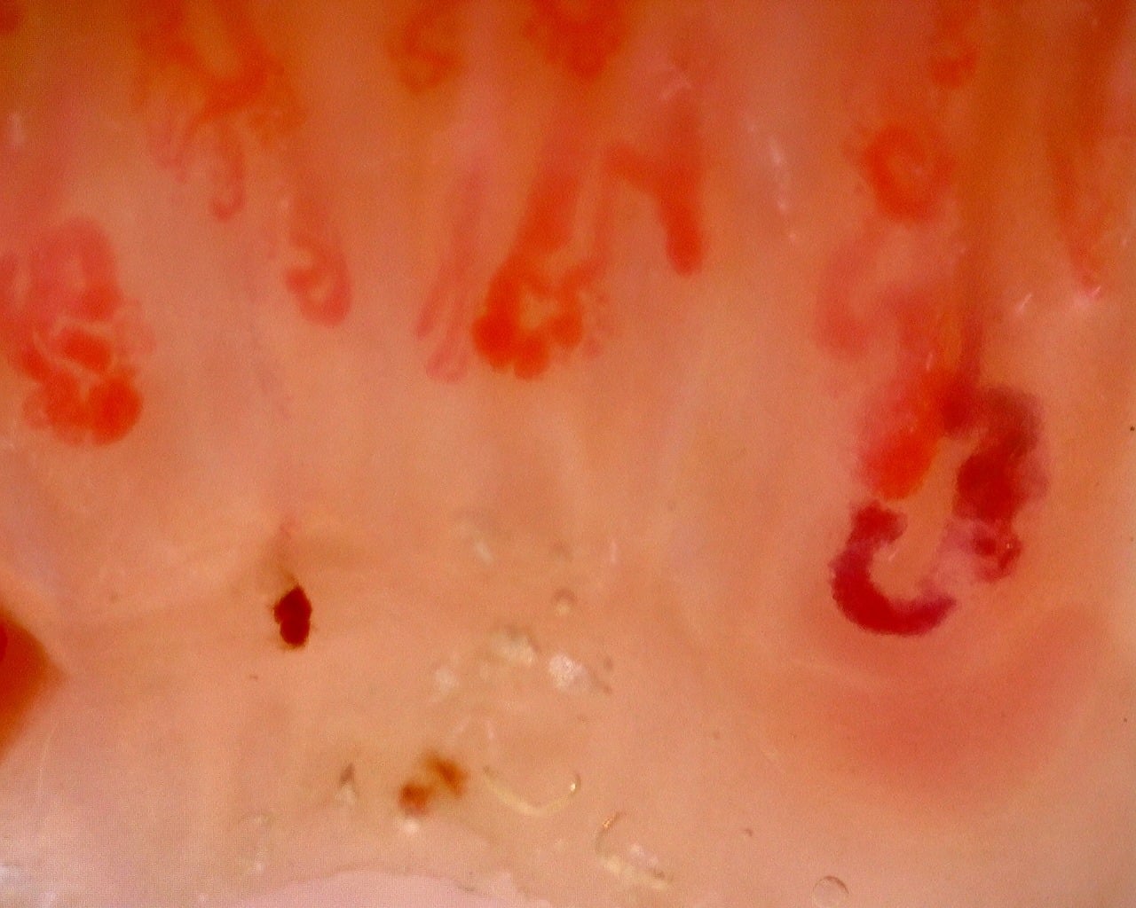 Nailfold capillaroscopy: left index finger, field b. Juvenile Dermatomyositis with Gottron Lesions and a Scleroderma-Like Pattern.