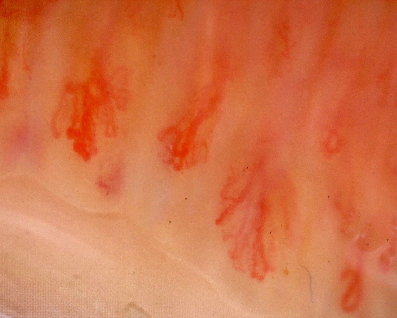 Nailfold capillaroscopy: left middle finger, field b. Juvenile Dermatomyositis with Gottron Lesions and a Scleroderma-Like Pattern.