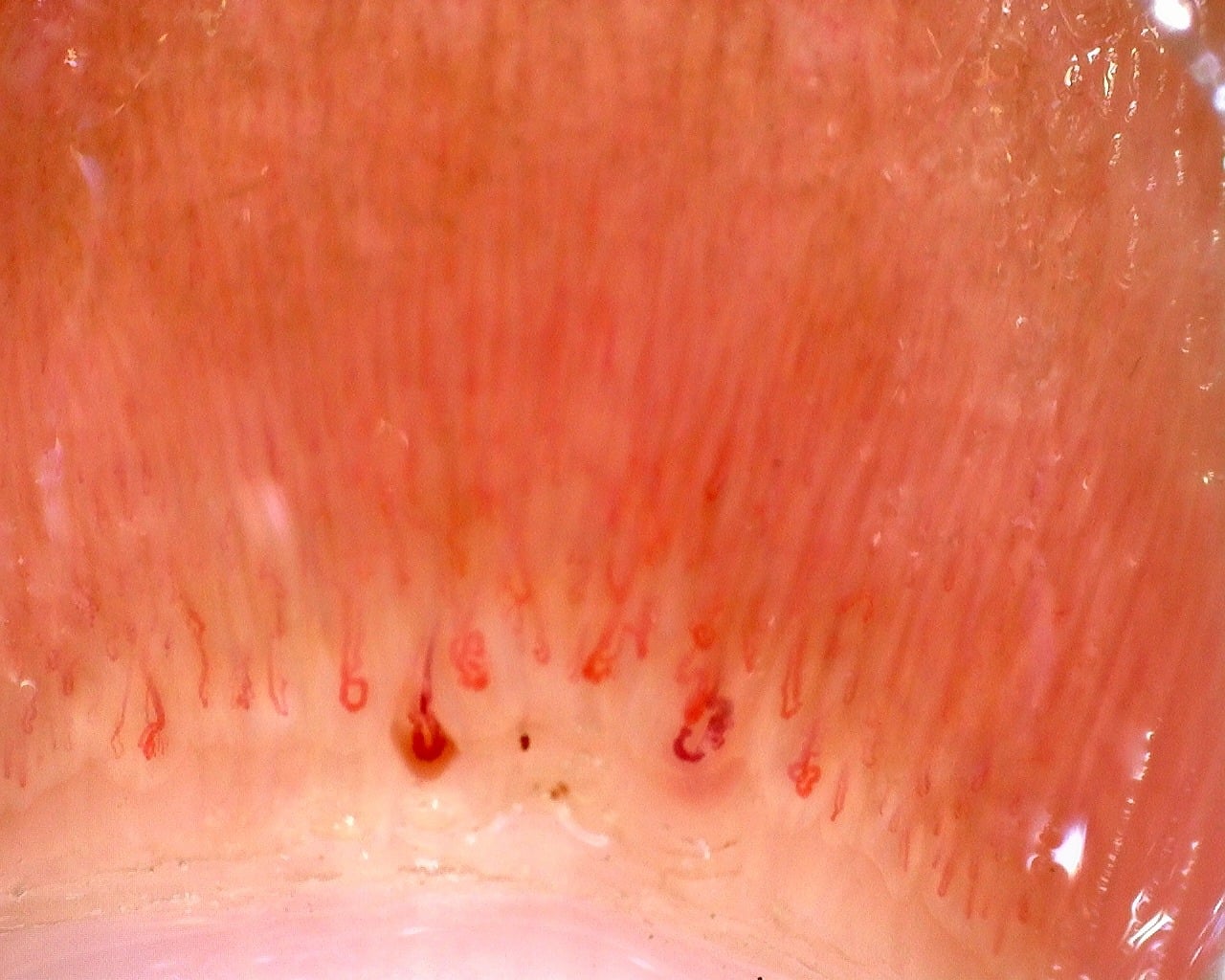 Preview image for Juvenile Dermatomyositis with Gottron Lesions and a Scleroderma-Like Pattern
