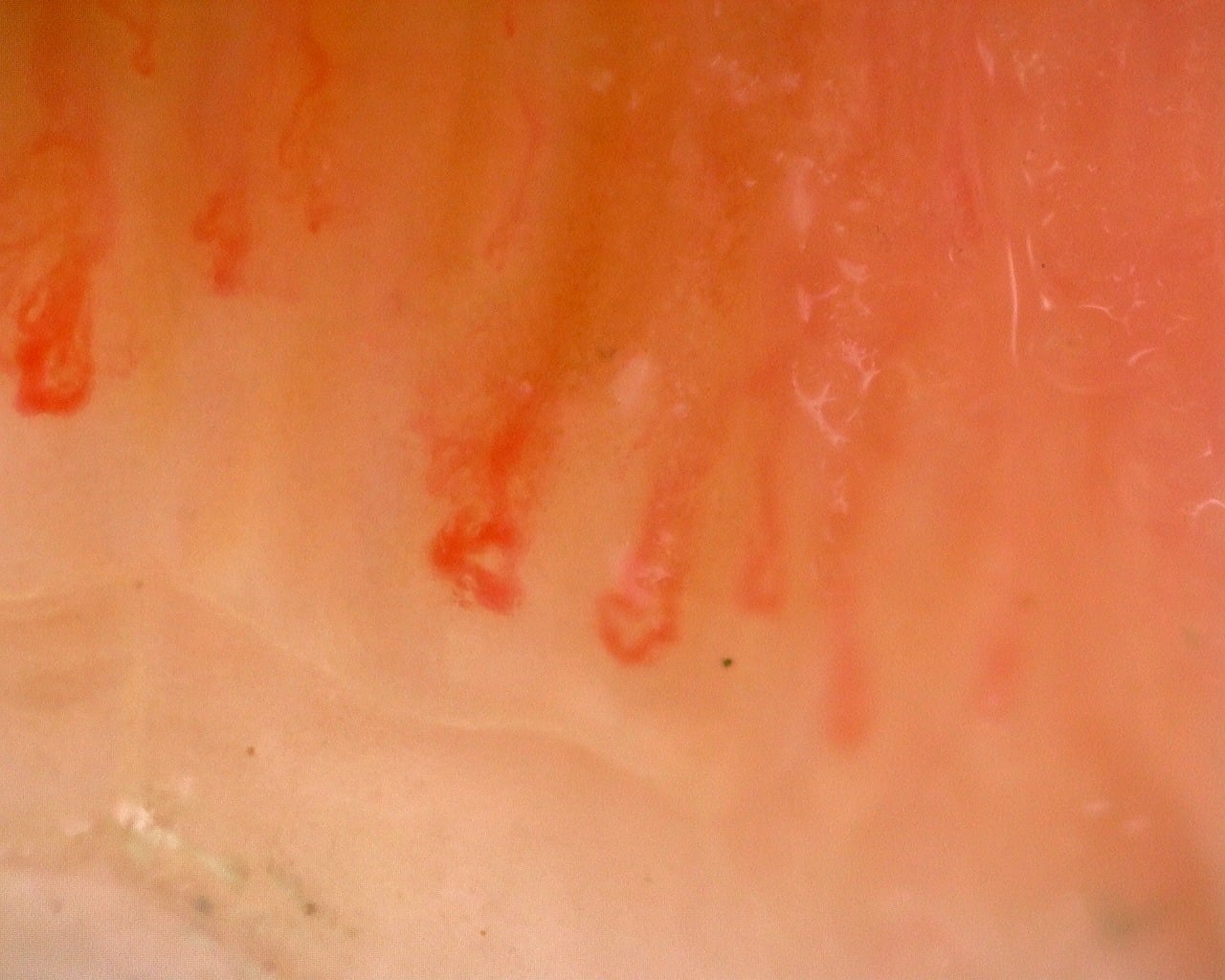 Nailfold capillaroscopy: right little finger, field a. Juvenile Dermatomyositis with Gottron Lesions and a Scleroderma-Like Pattern.