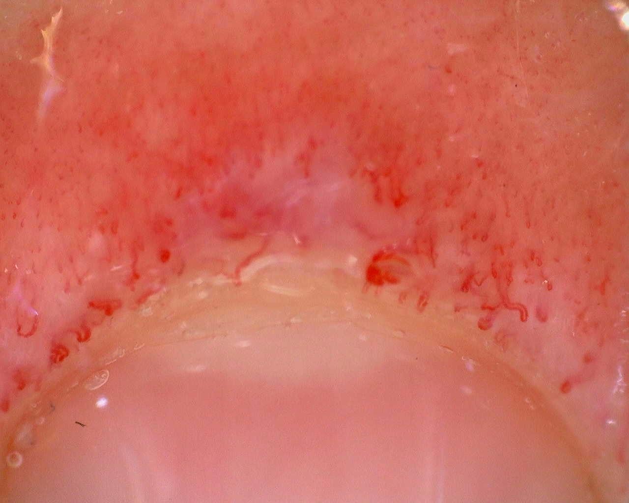 Preview image for Juvenile Dermatomyositis anti-TIF1 with Active Scleroderma-Like Pattern