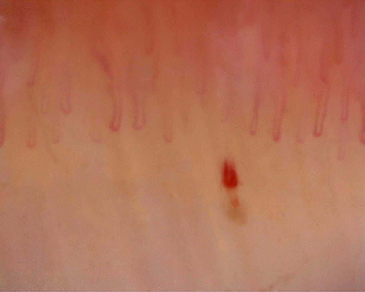Nailfold capillaroscopy: left middle finger, field a. Follow-up study. Mixed Connective Tissue Disease Presenting with Raynaud Phenomenon.