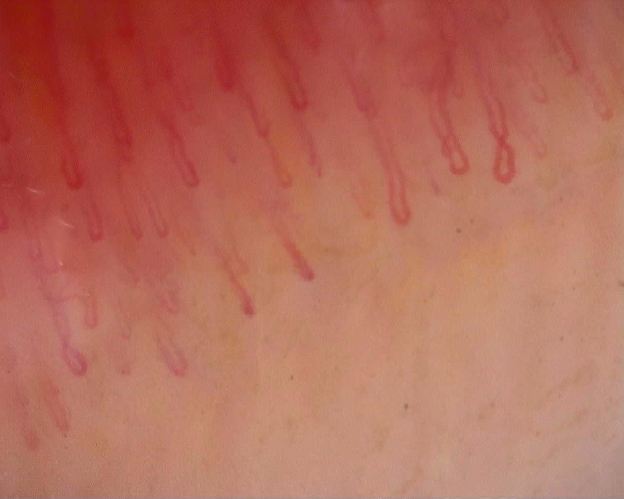 Nailfold capillaroscopy: right index finger, field a. Follow-up study. Mixed Connective Tissue Disease Presenting with Raynaud Phenomenon.