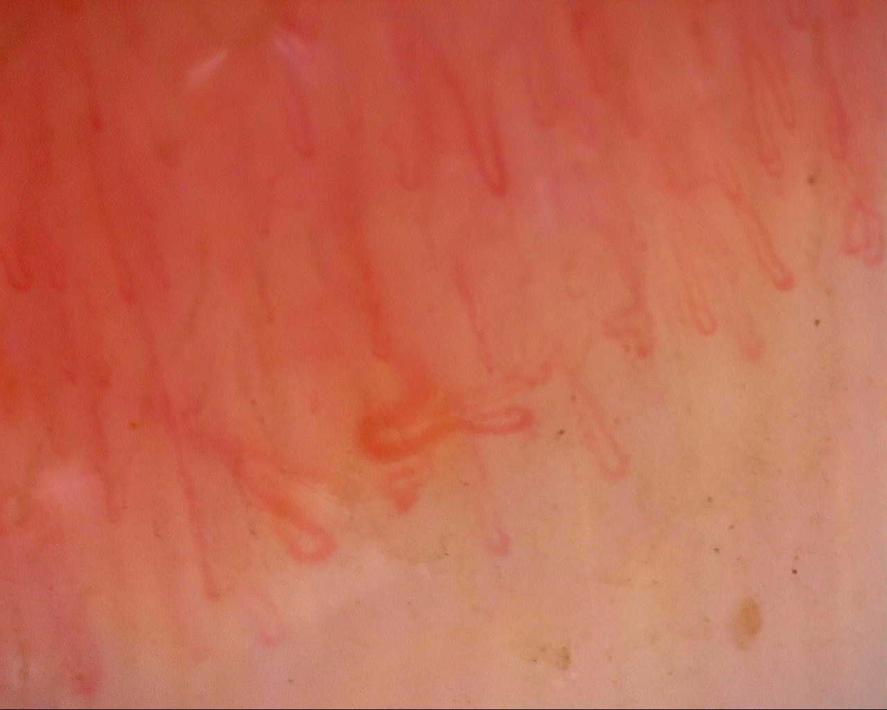 Nailfold capillaroscopy: right middle finger, field a. Follow-up study. Mixed Connective Tissue Disease Presenting with Raynaud Phenomenon.