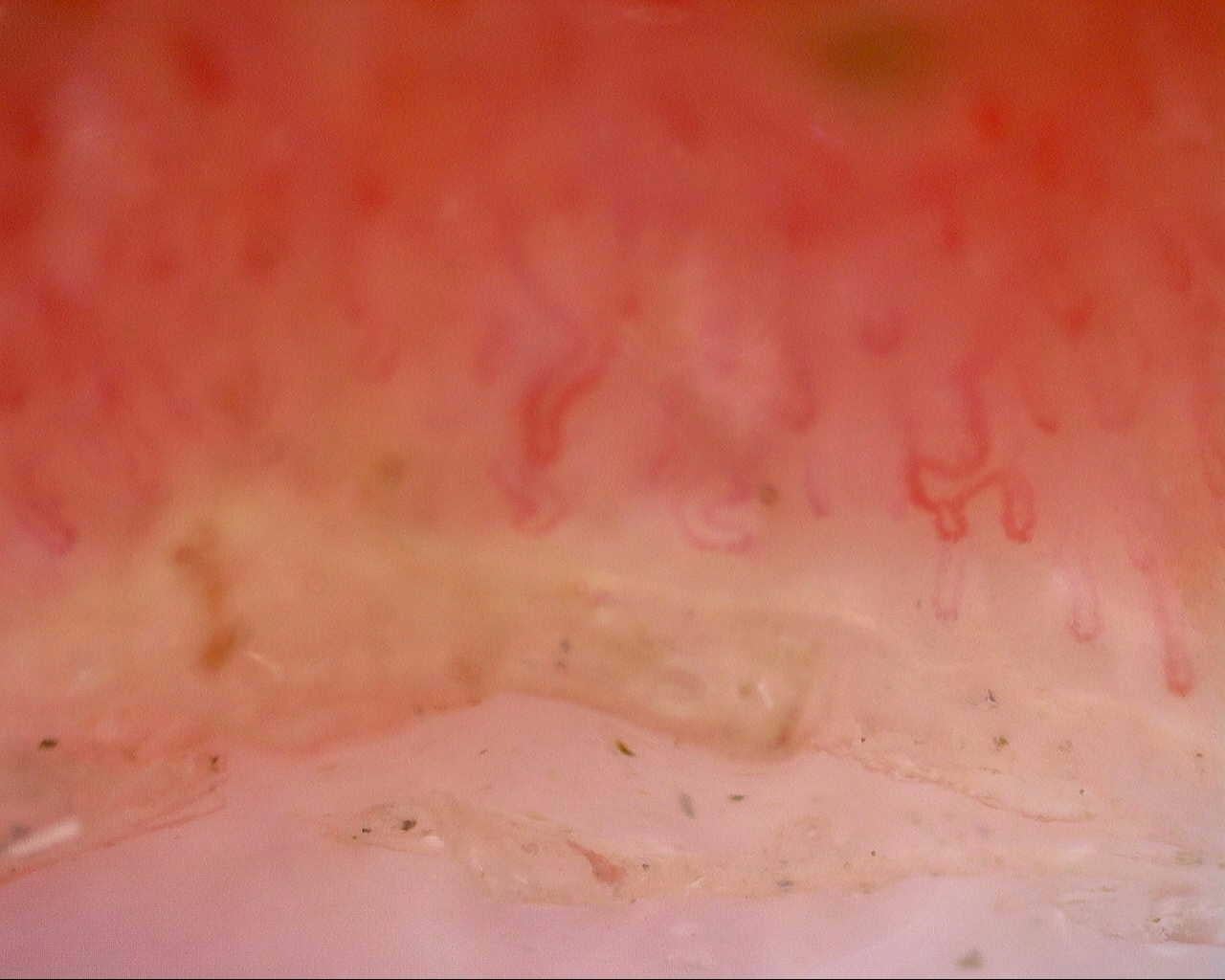 Nailfold capillaroscopy: right little finger, field a. Follow-up study. Mixed Connective Tissue Disease Presenting with Raynaud Phenomenon.