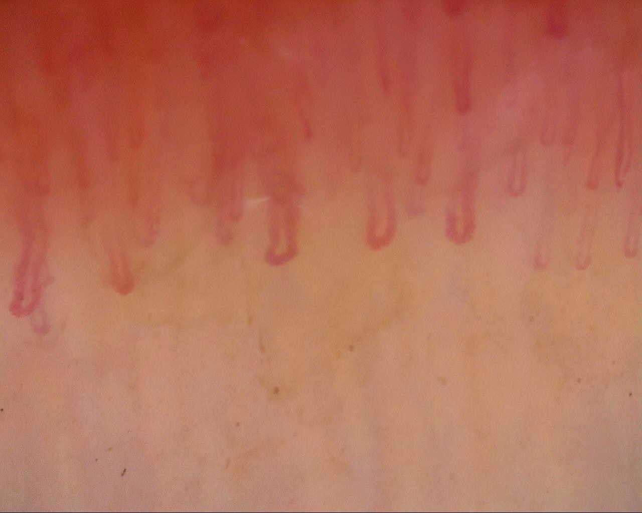 Nailfold capillaroscopy: left middle finger, field a. Follow-up study. Mixed Connective Tissue Disease Presenting with Raynaud Phenomenon.