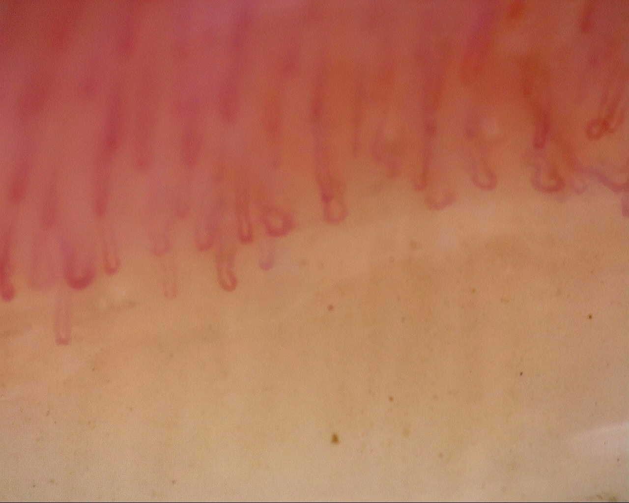 Nailfold capillaroscopy: left index finger, field a. Follow-up study. Mixed Connective Tissue Disease Presenting with Raynaud Phenomenon.