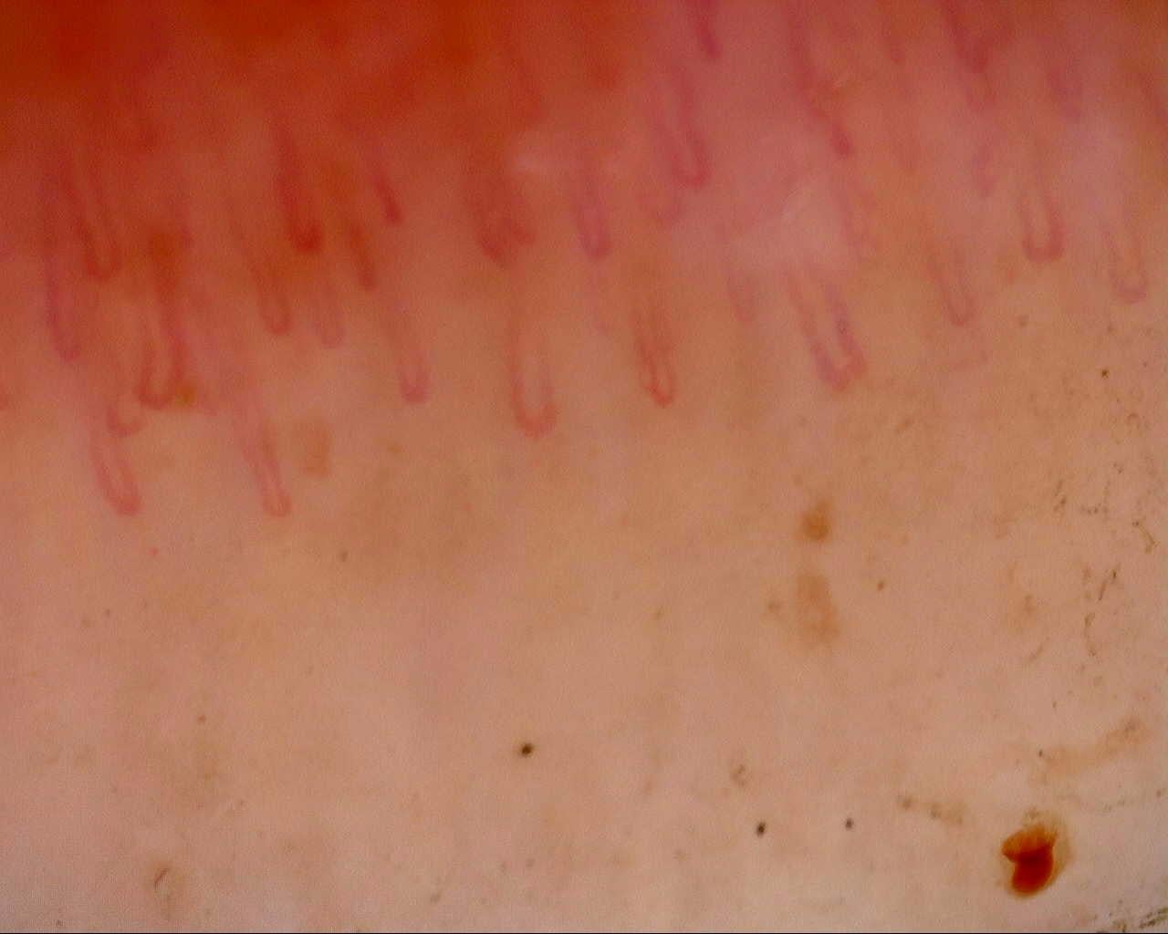 Nailfold capillaroscopy: right index finger, field a. Follow-up study. Mixed Connective Tissue Disease Presenting with Raynaud Phenomenon.