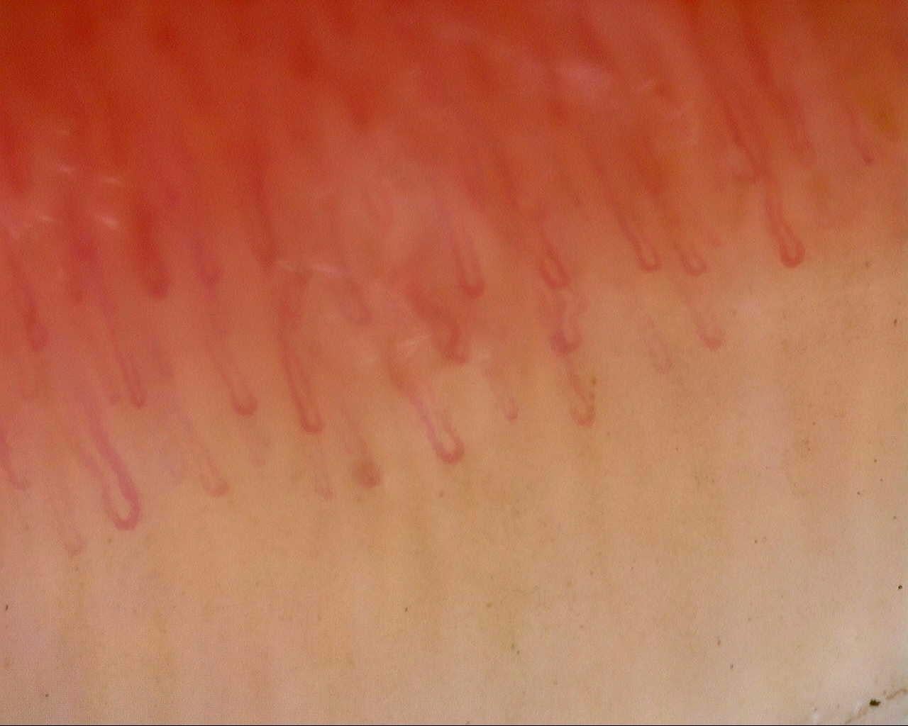 Nailfold capillaroscopy: right middle finger, field a. Follow-up study. Mixed Connective Tissue Disease Presenting with Raynaud Phenomenon.