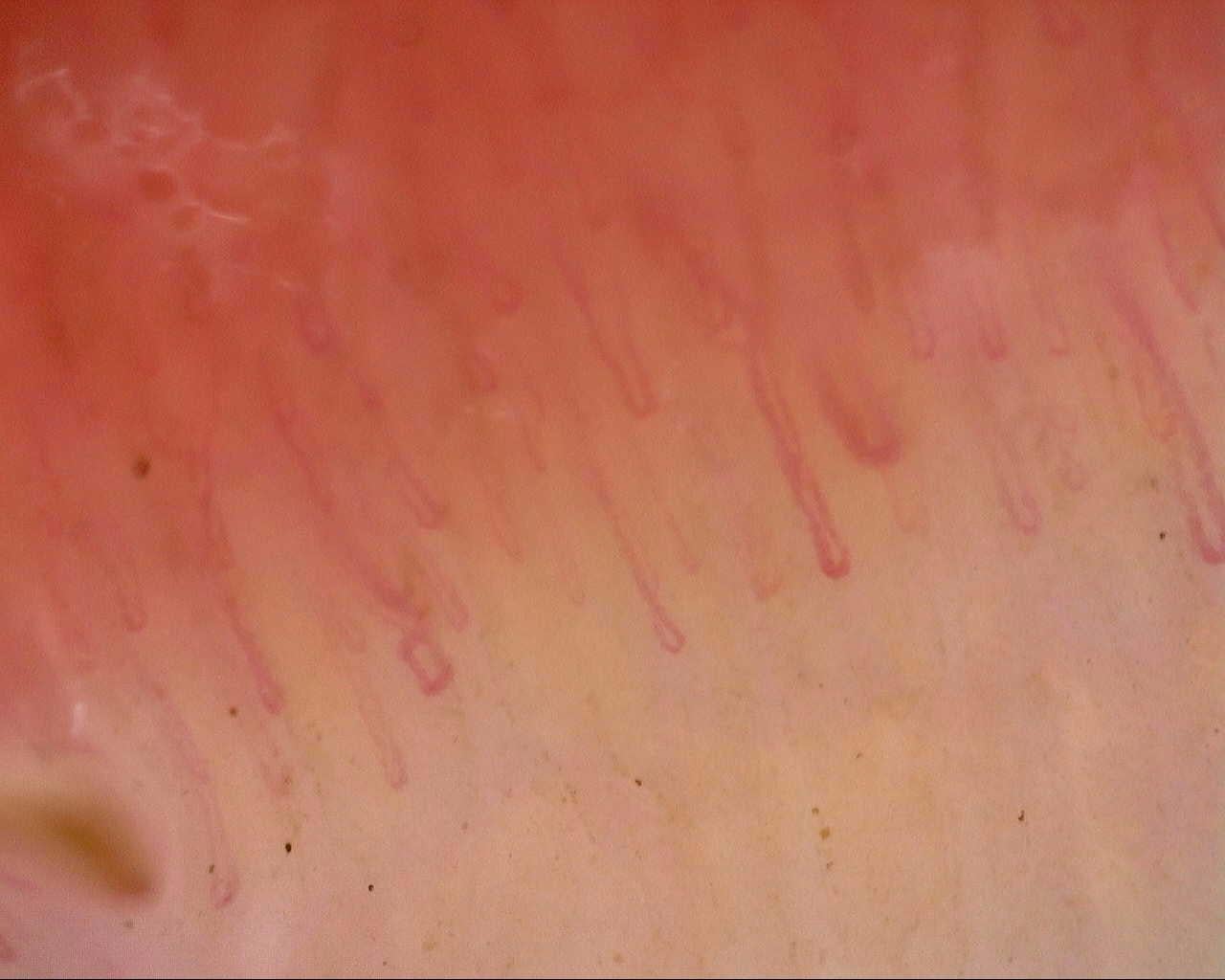 Nailfold capillaroscopy: right ring finger, field a. Follow-up study. Mixed Connective Tissue Disease Presenting with Raynaud Phenomenon.