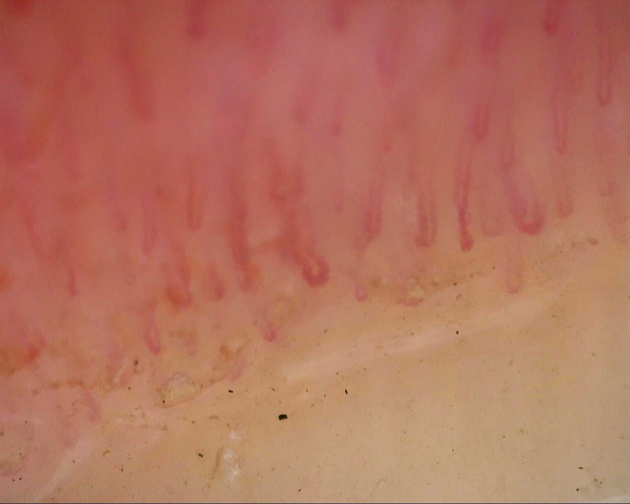 Nailfold capillaroscopy: left index finger, field a. Follow-up study. Mixed Connective Tissue Disease Presenting with Raynaud Phenomenon.