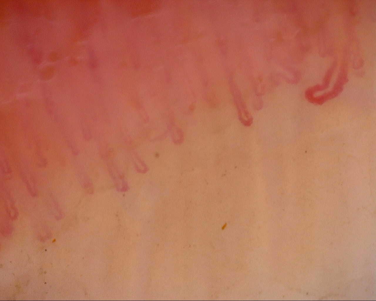 Nailfold capillaroscopy: left middle finger, field a. Follow-up study. Mixed Connective Tissue Disease Presenting with Raynaud Phenomenon.