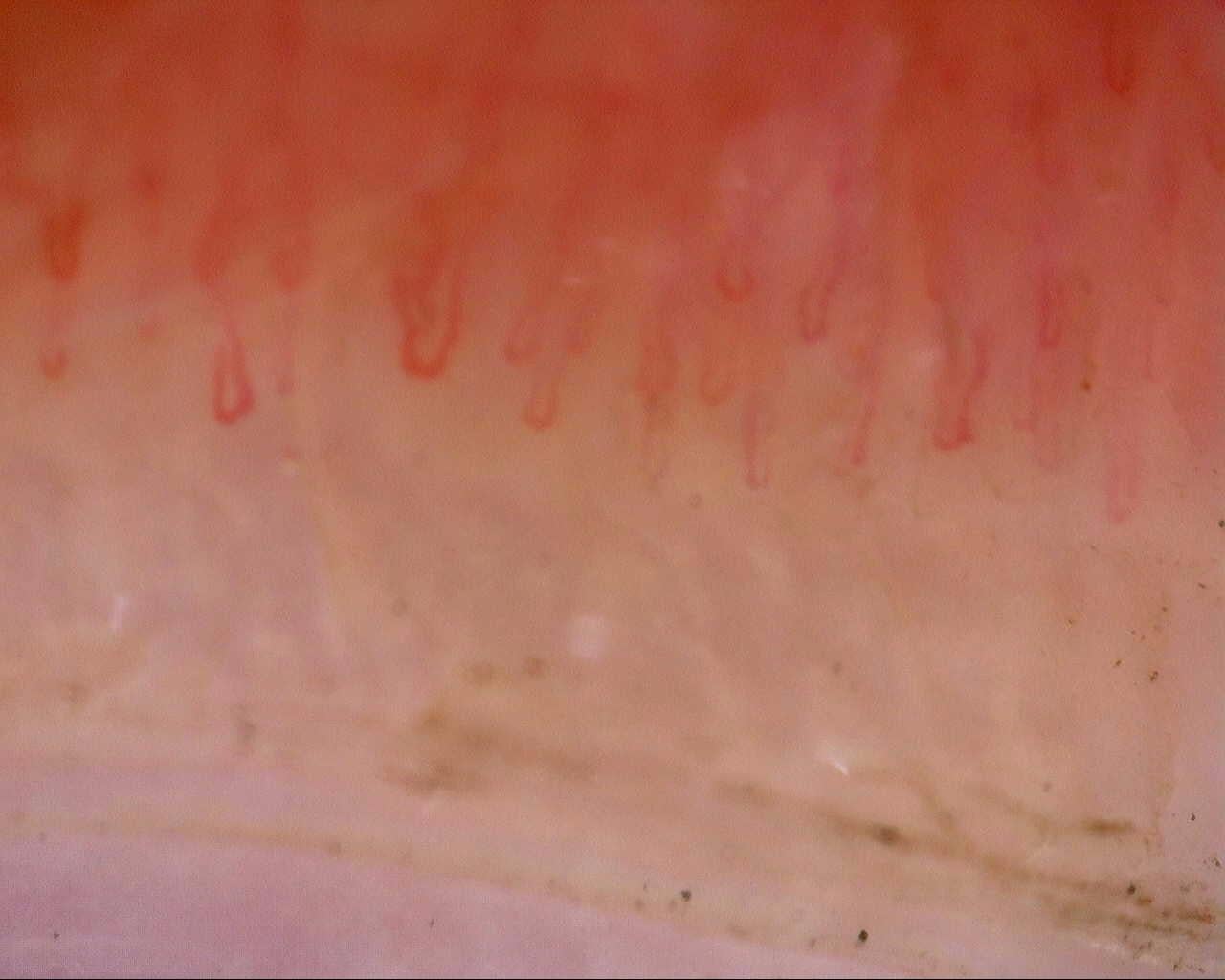 Nailfold capillaroscopy: left little finger, field a. Follow-up study. Mixed Connective Tissue Disease Presenting with Raynaud Phenomenon.