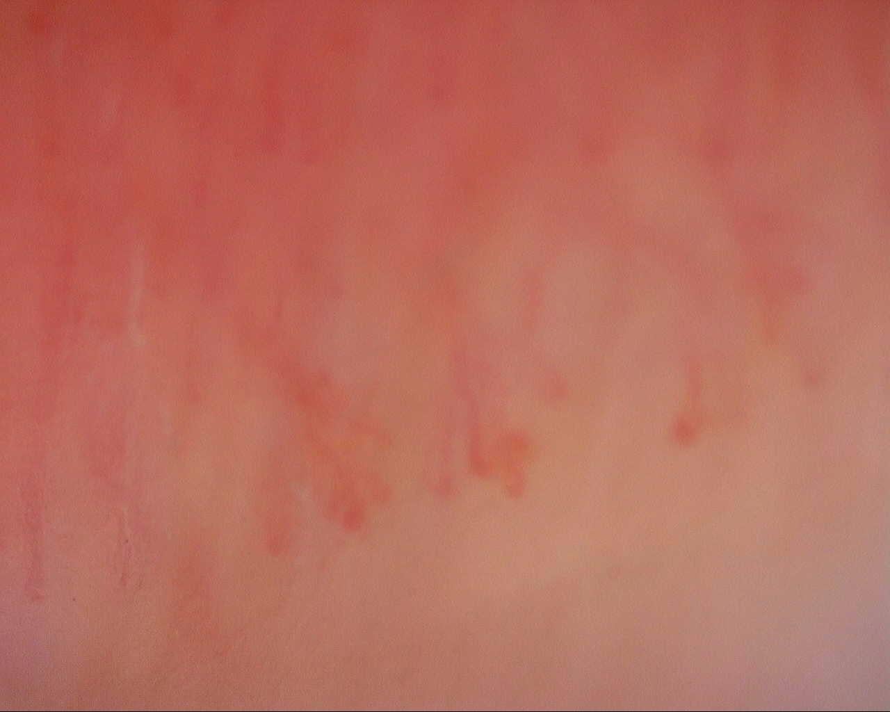 Nailfold capillaroscopy: left middle finger, field d. Initial study. Mixed Connective Tissue Disease Presenting with Raynaud Phenomenon.