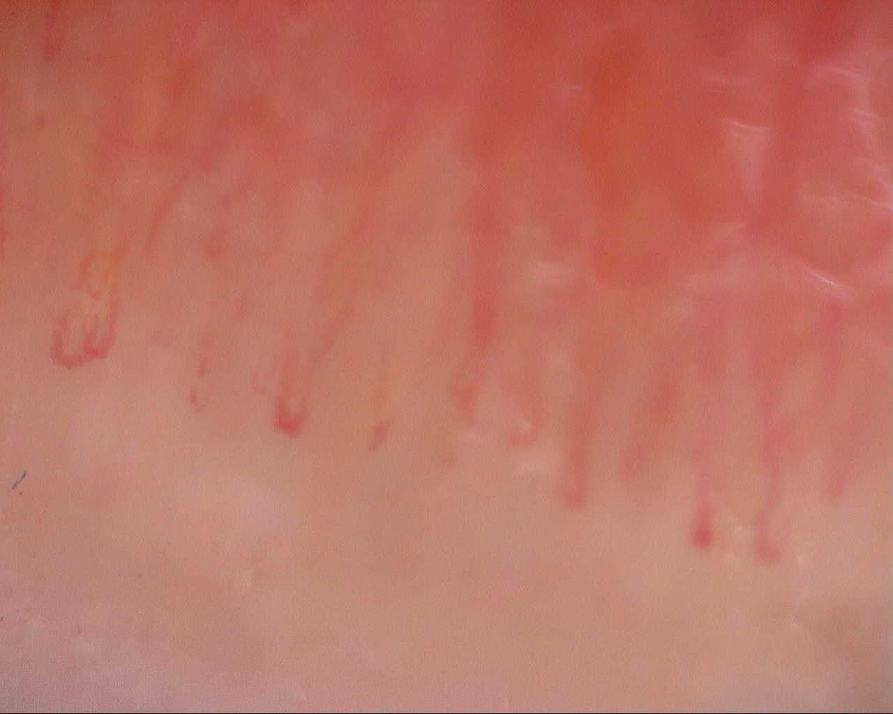 Nailfold capillaroscopy: left middle finger, field a. Initial study. Mixed Connective Tissue Disease Presenting with Raynaud Phenomenon.