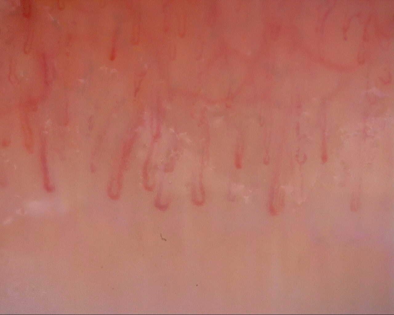 Nailfold capillaroscopy: right ring finger, field d. Initial study. Mixed Connective Tissue Disease Presenting with Raynaud Phenomenon.